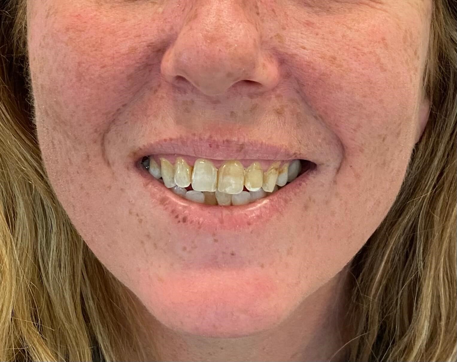 Front Porcelain Veneers Before