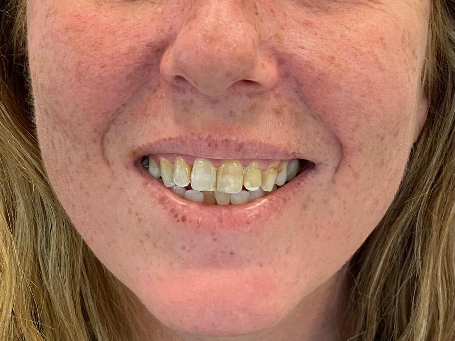 Front Porcelain Veneers Before