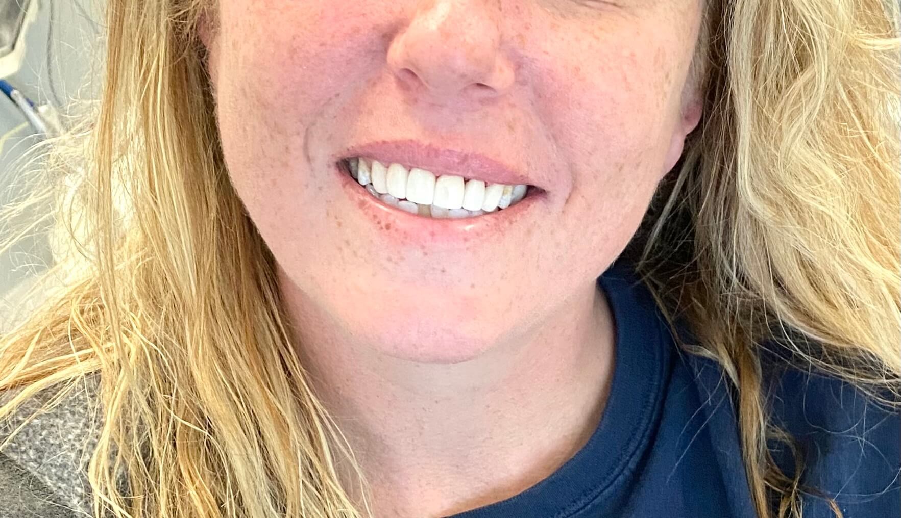 Front Porcelain Veneers After