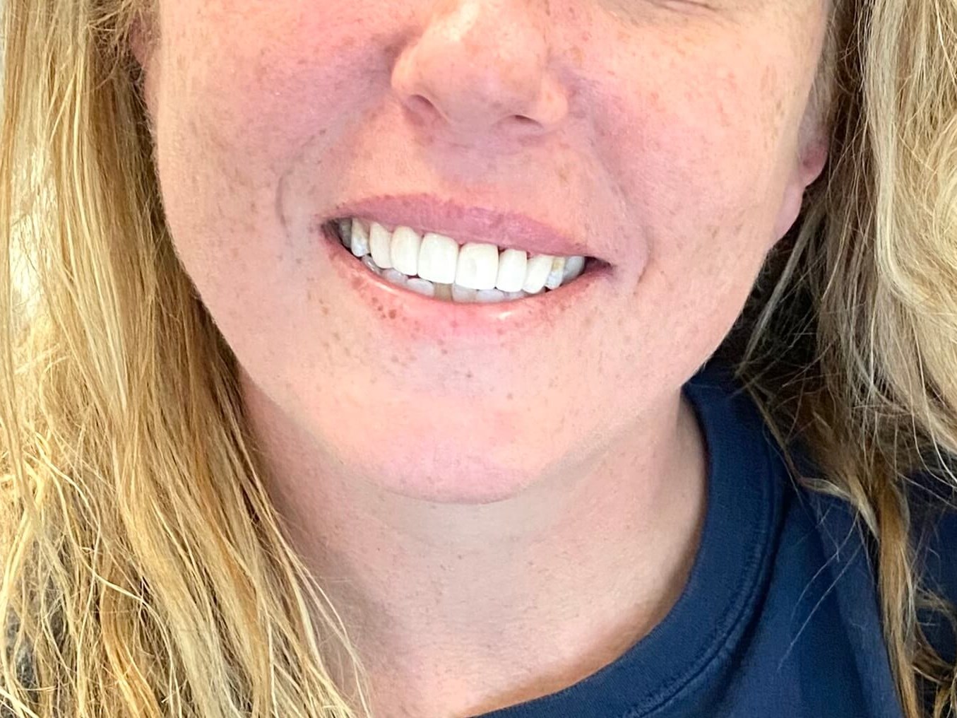 Front Porcelain Veneers After