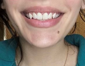 Laser Gum Lift After