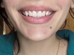 Laser Gum Lift After