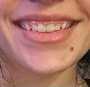 Laser Gum Lift Before