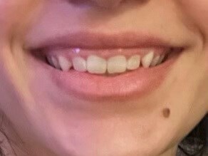 Laser Gum Lift Before