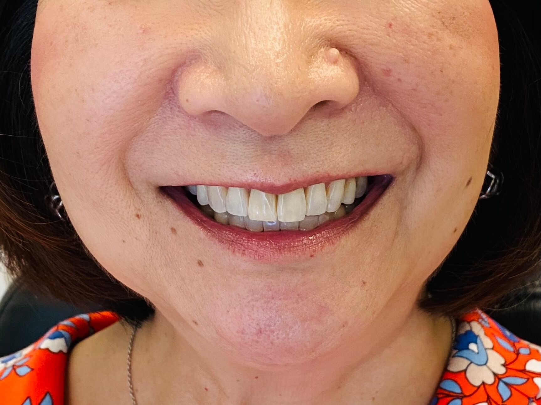 Cosmetic Dentistry After