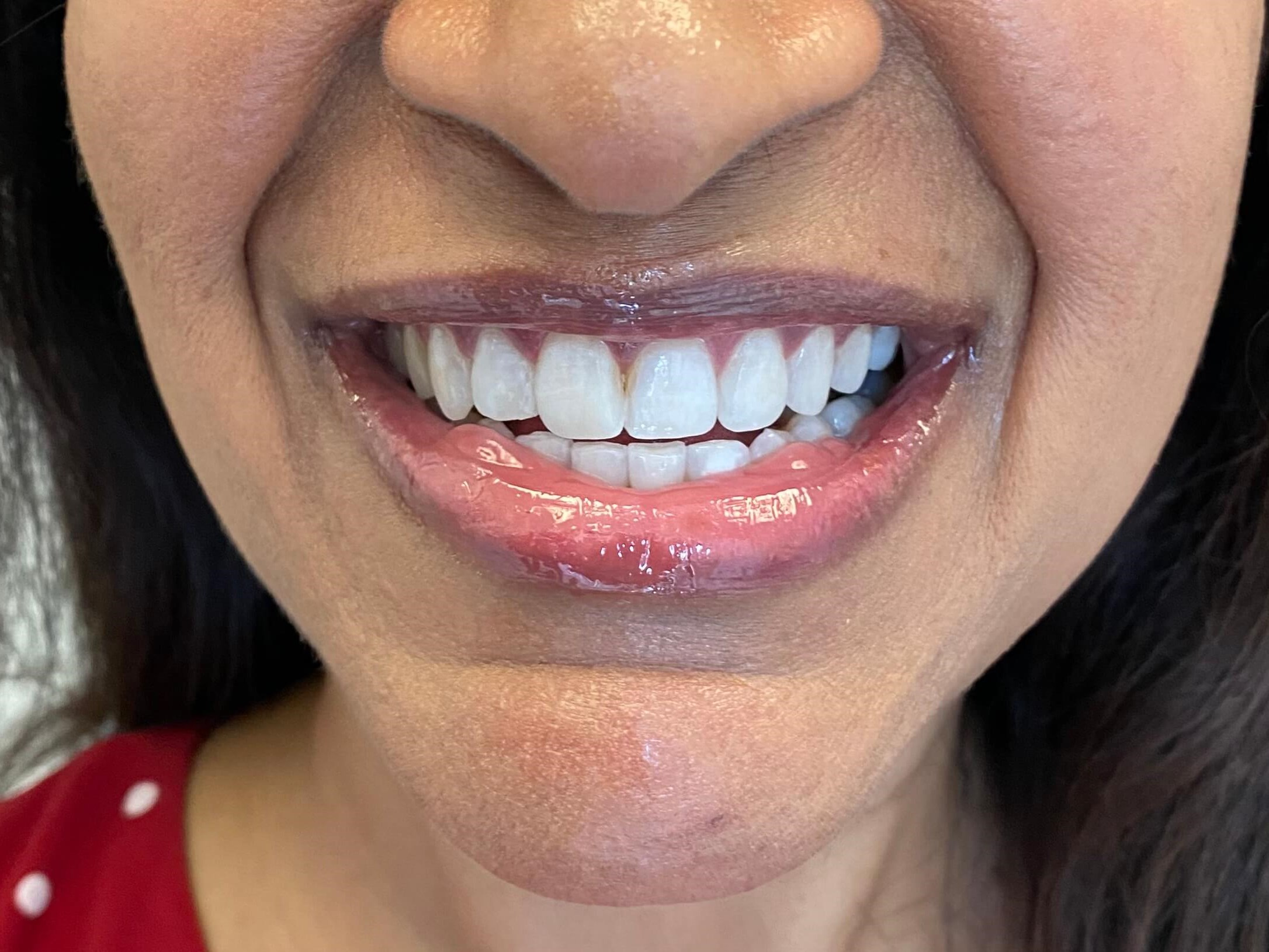 Cosmetic Dentistry After