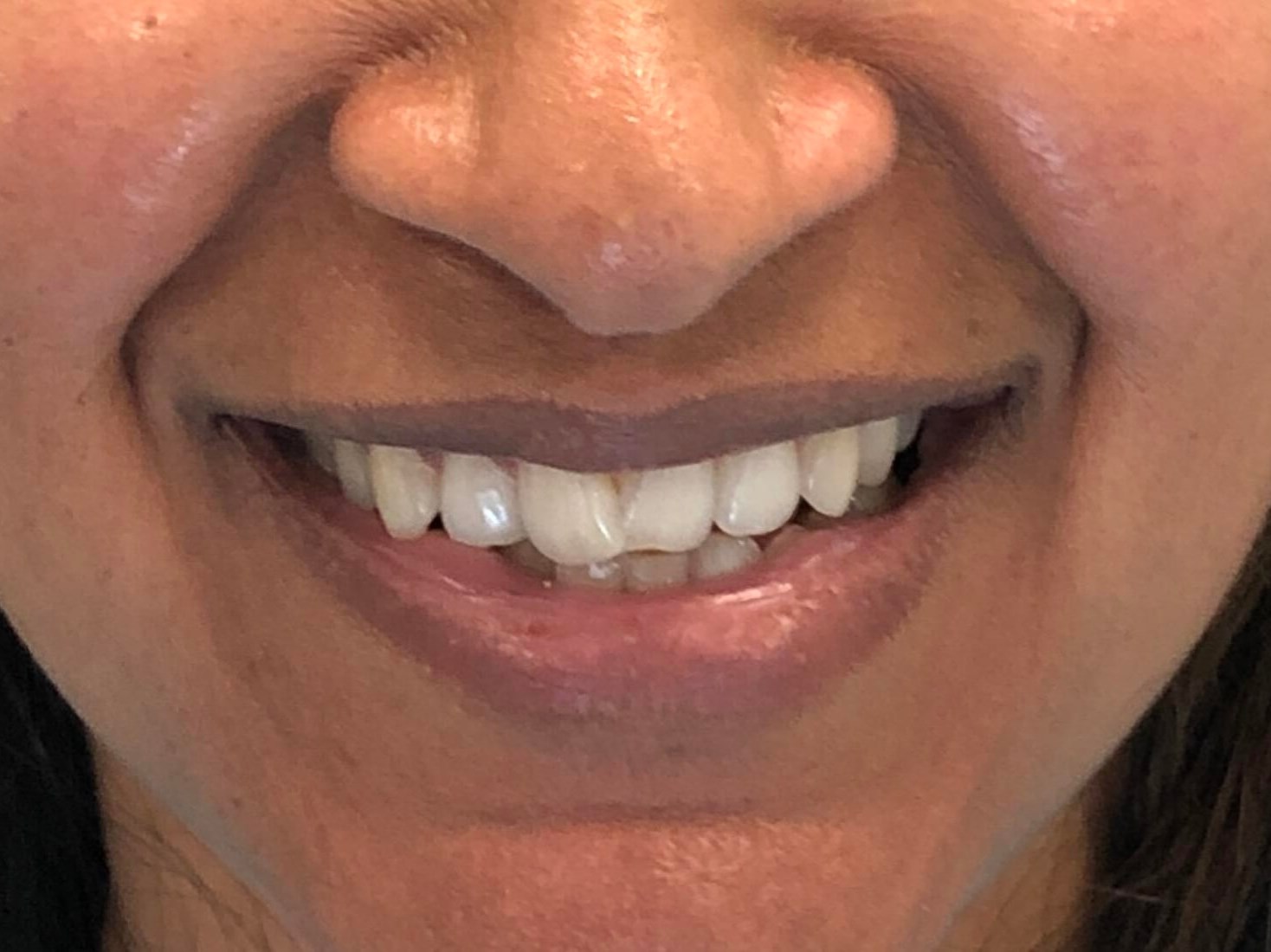 Cosmetic Dentistry Before
