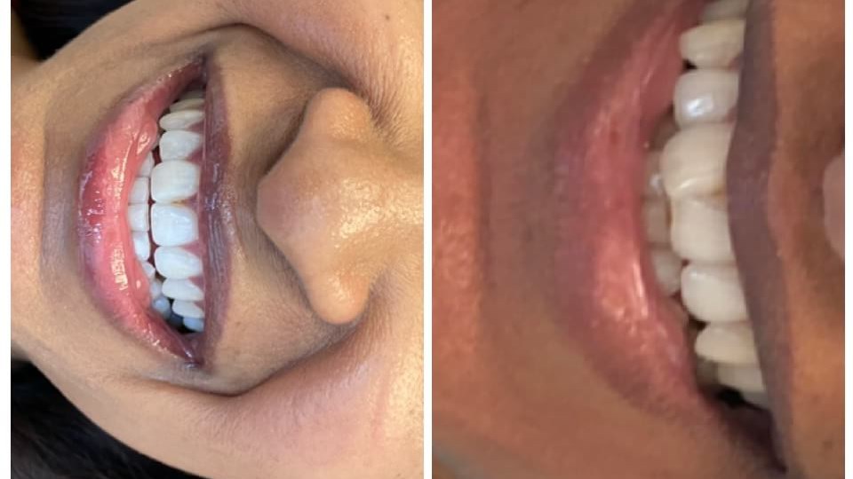 Achieving a Confident Smile with Invisalign Clear Braces
