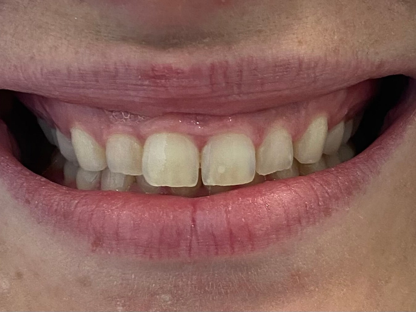 Gum Lift Procedure & Bonding Before