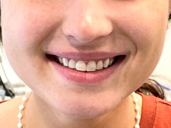 Gum Lift Procedure & Bonding After