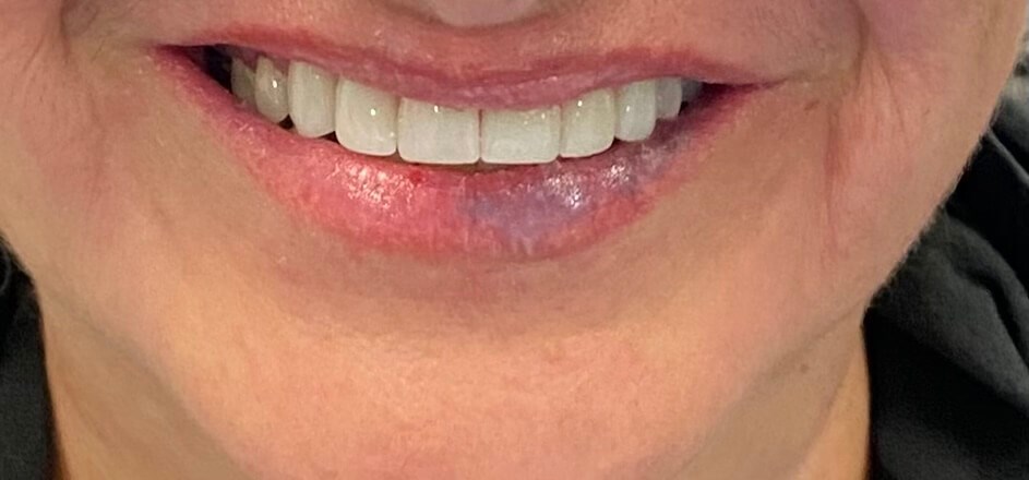 Cosmetic Dentistry After