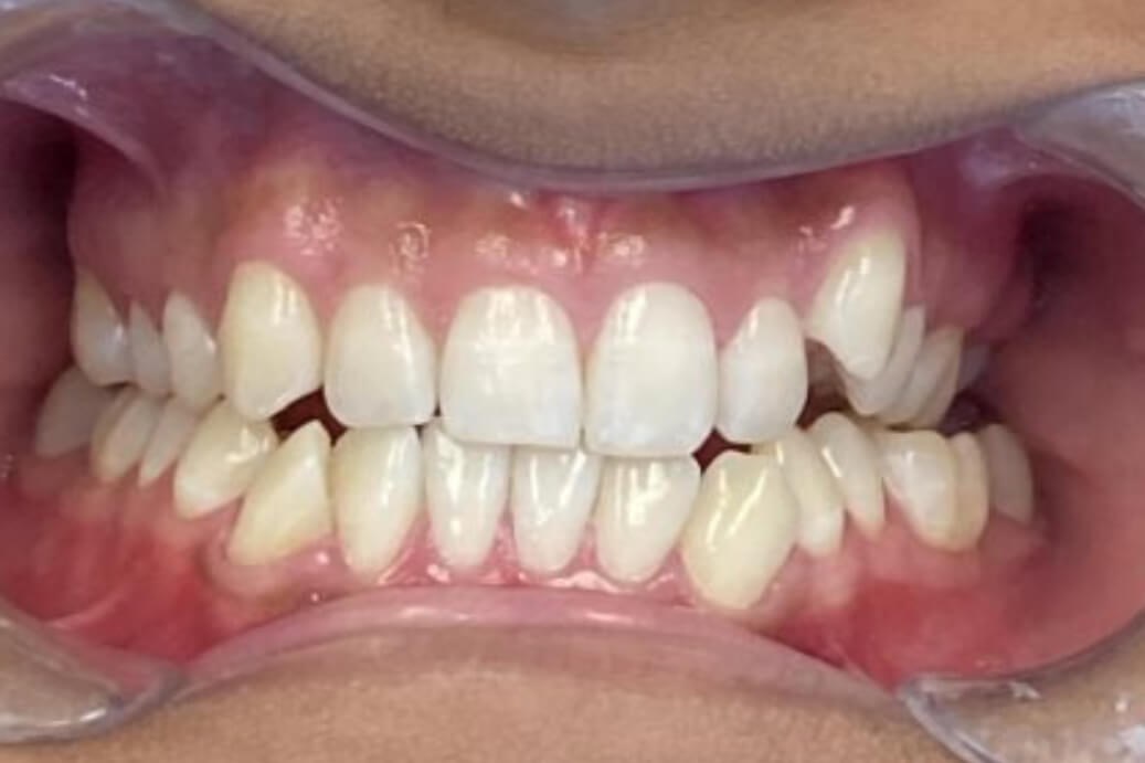 Invisalign Before