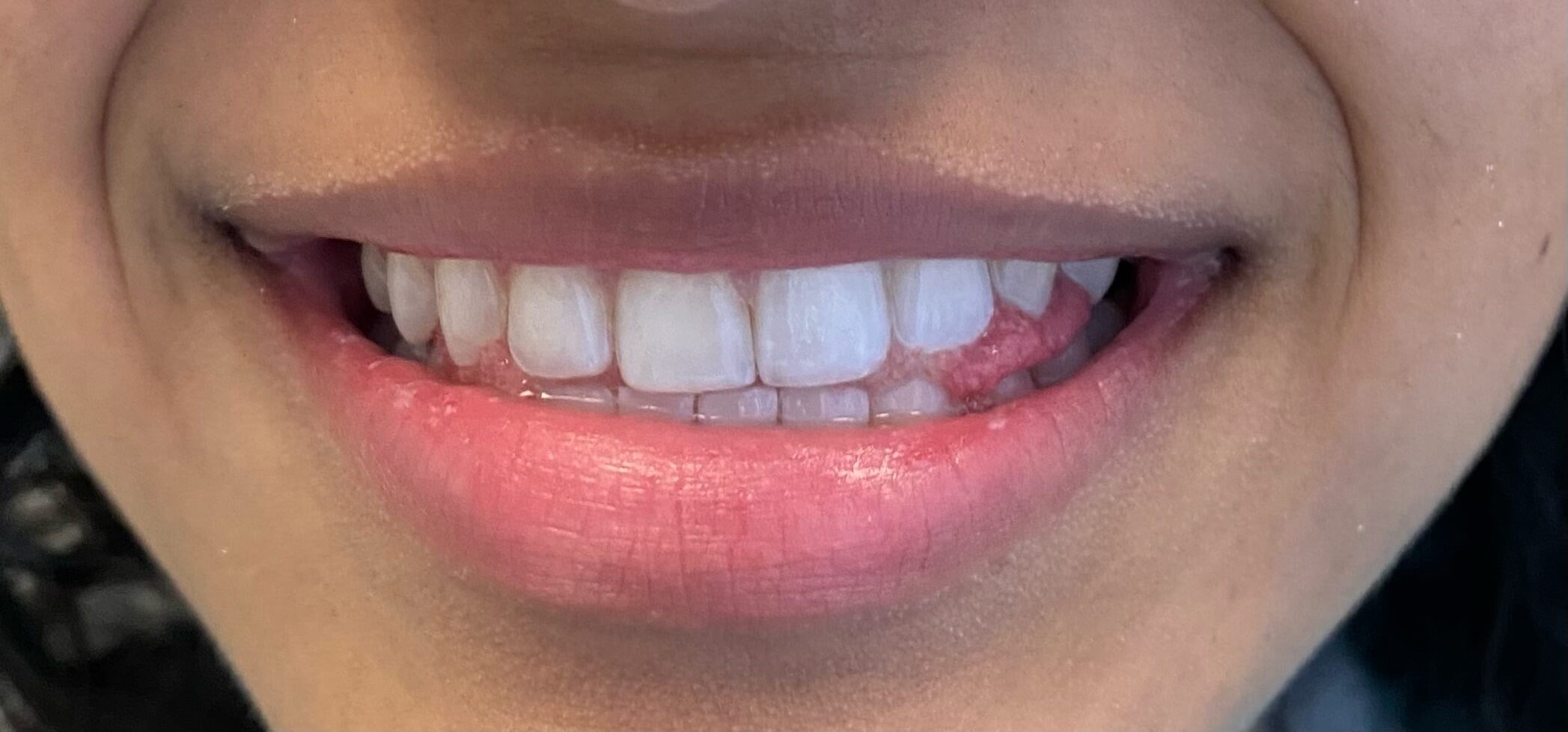 Invisalign After