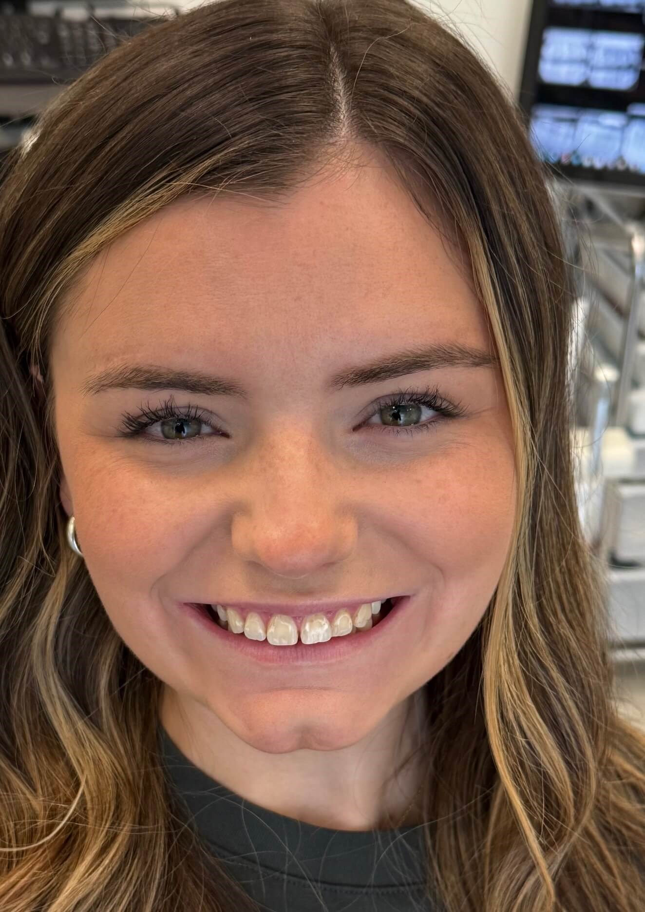 Smile Makeover Before