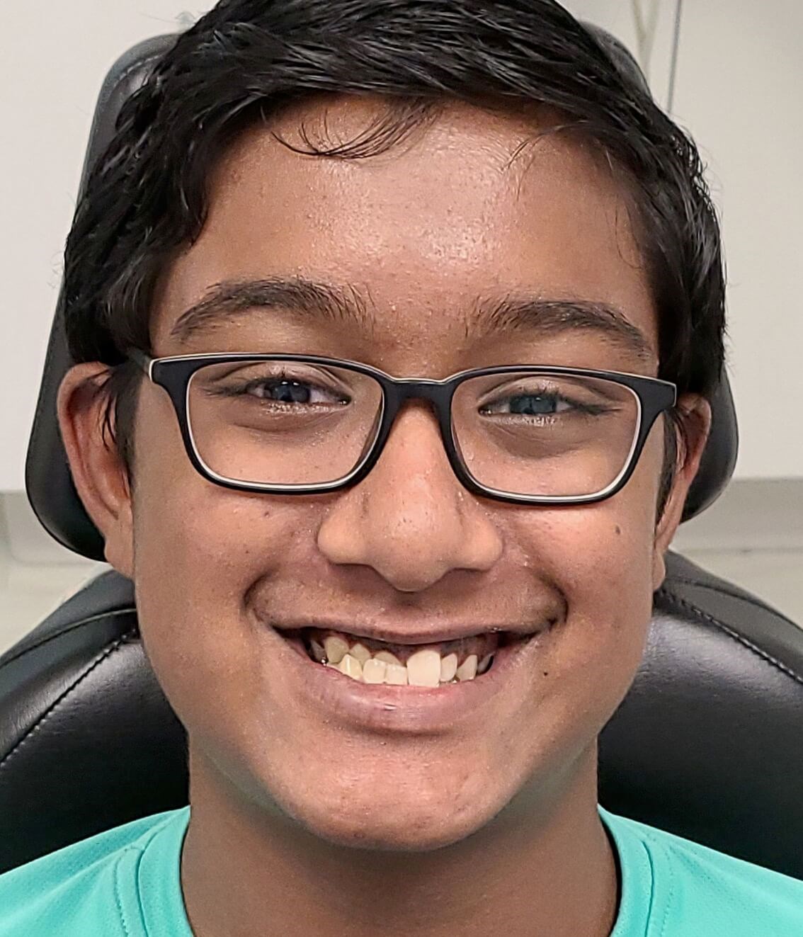 Invisalign® Transformation Before