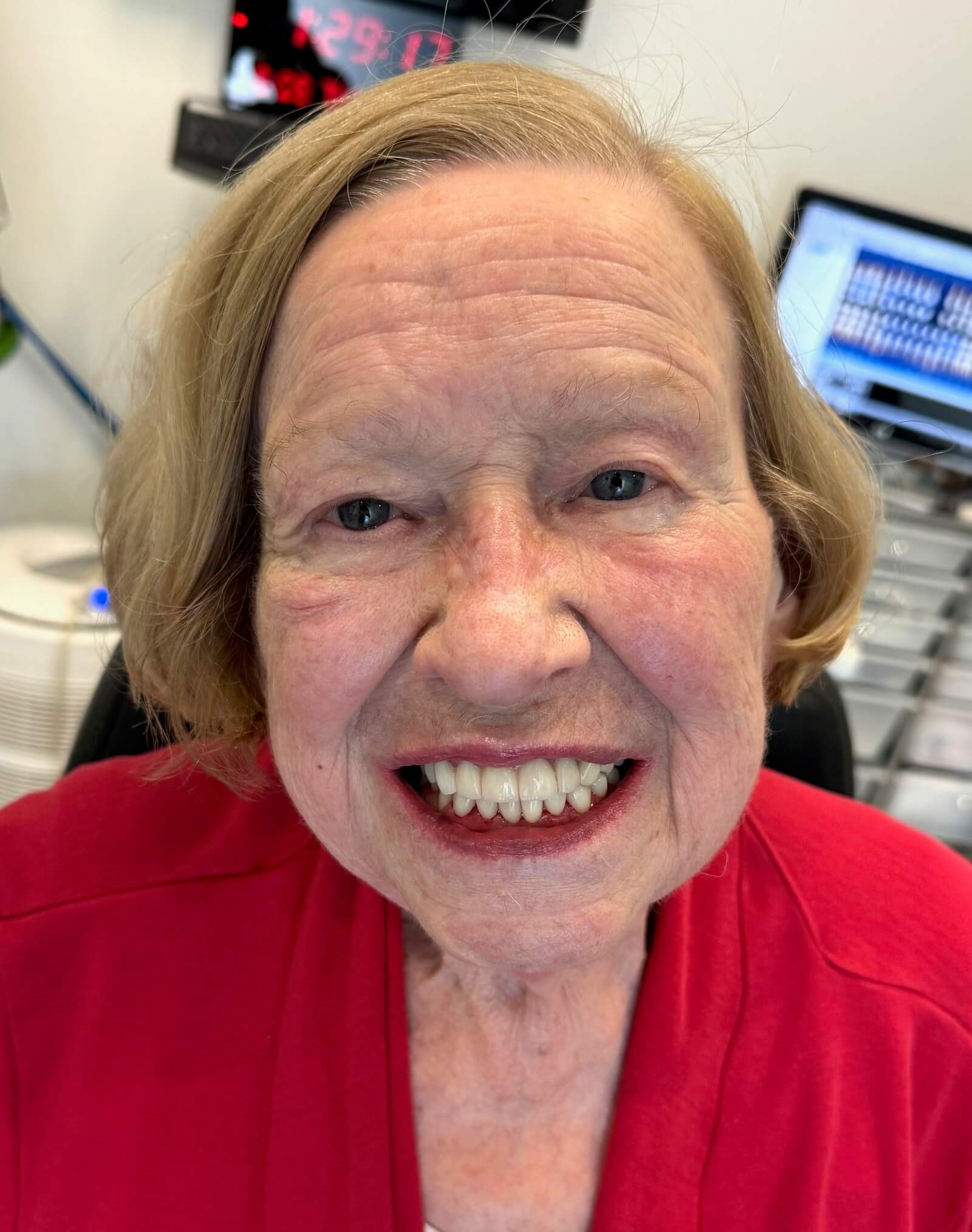 Smile Makeover After