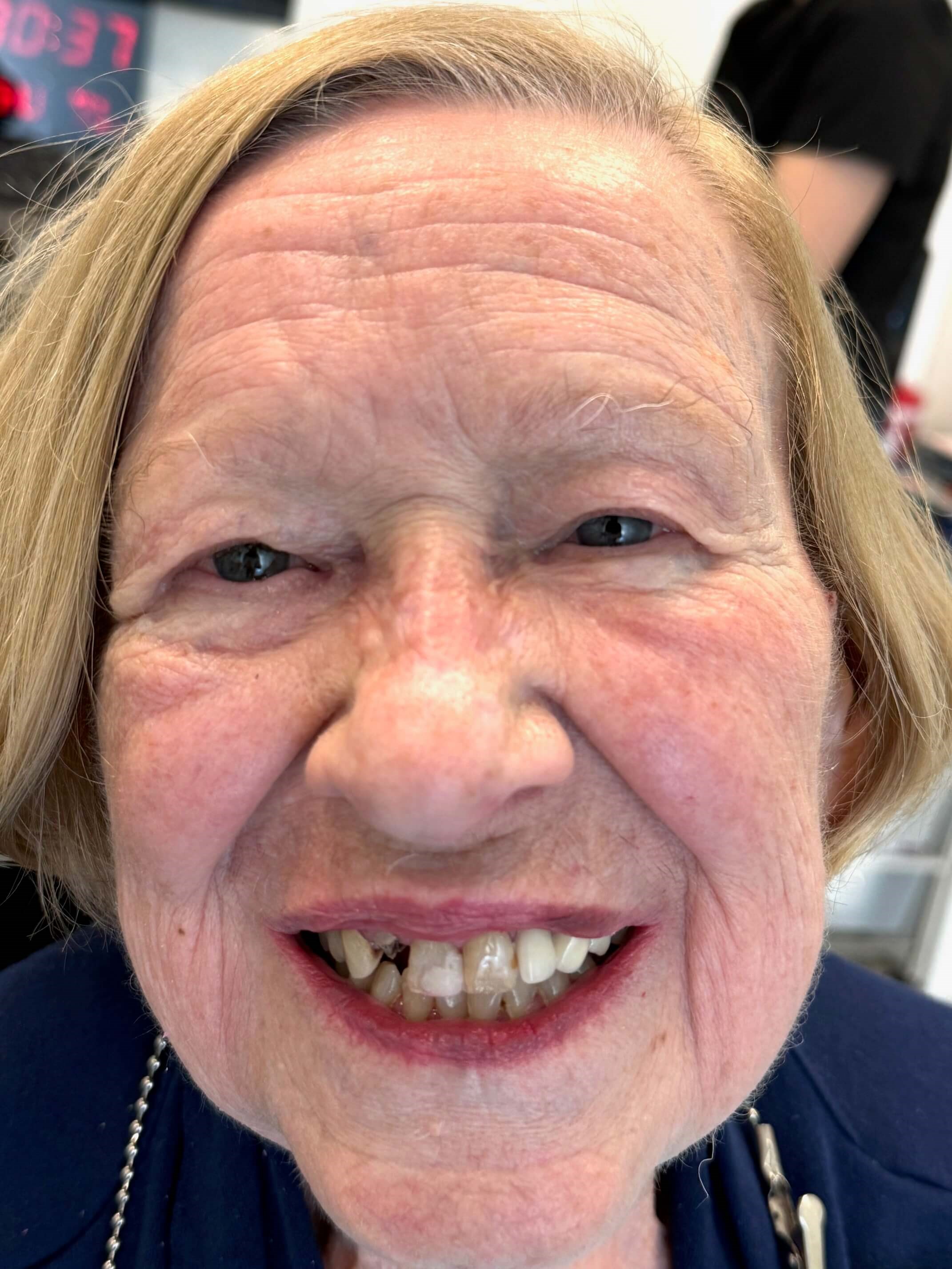 Smile Makeover Before