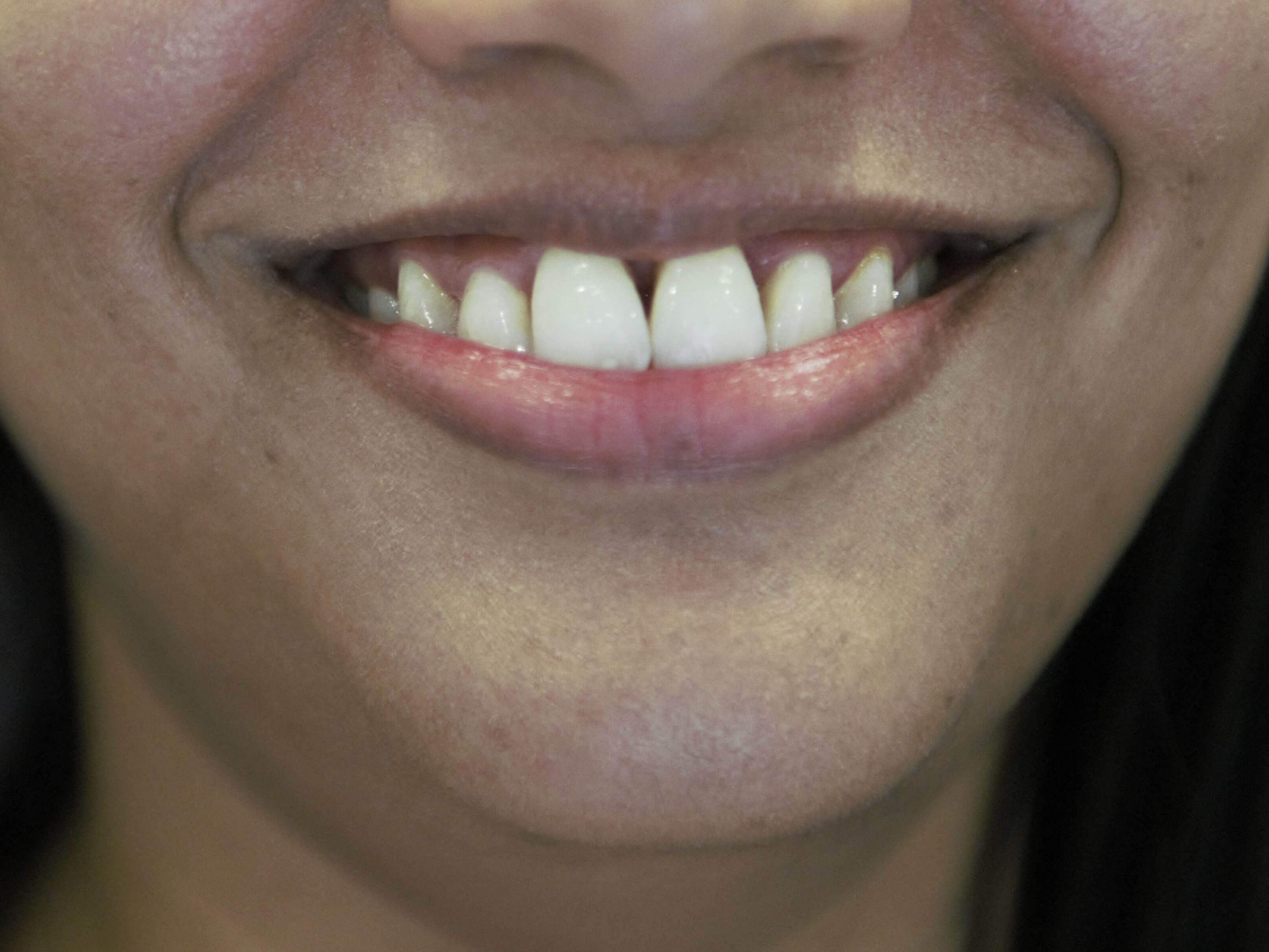 Porcelain Veneers Before