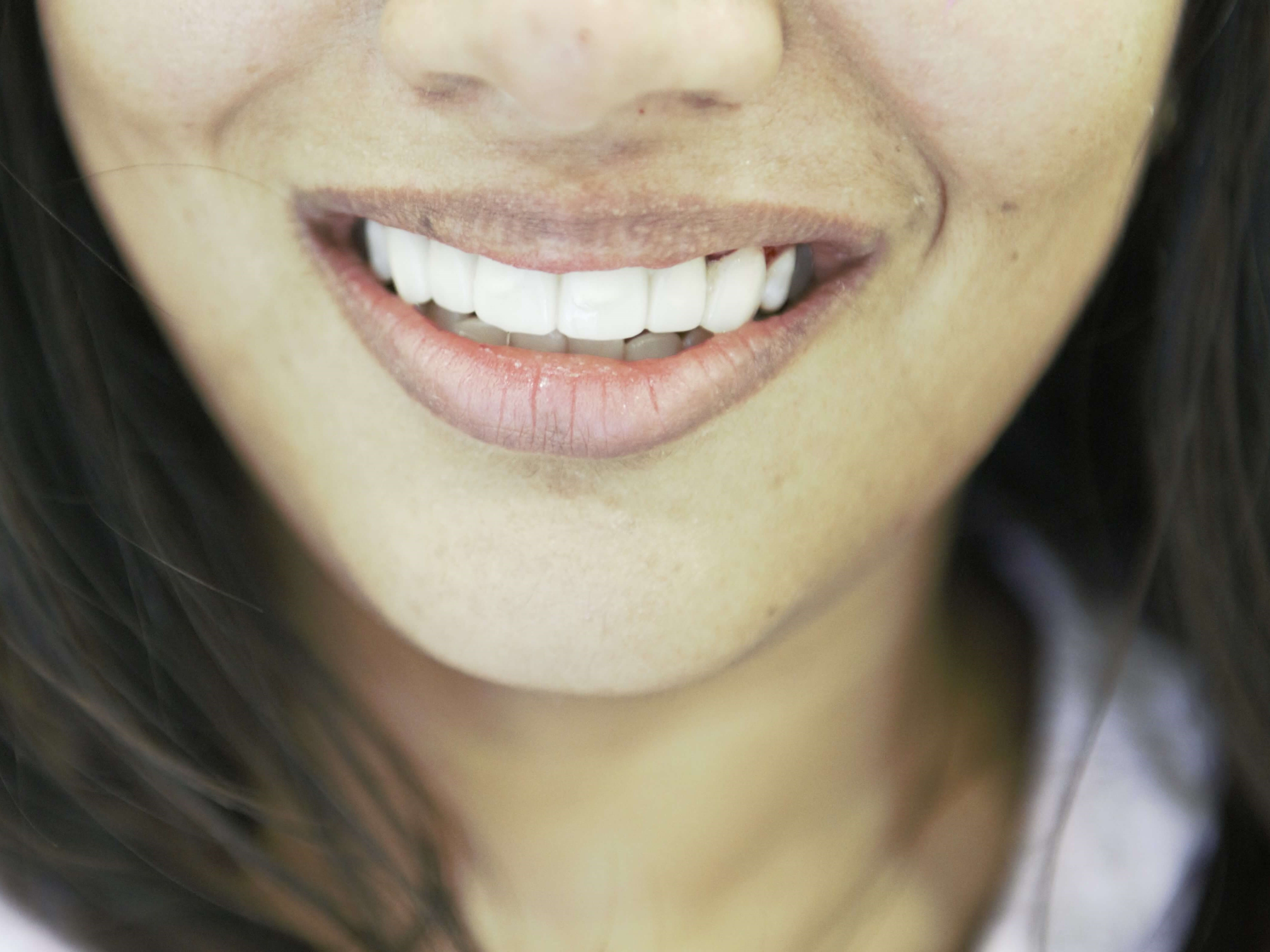 Porcelain Veneers After