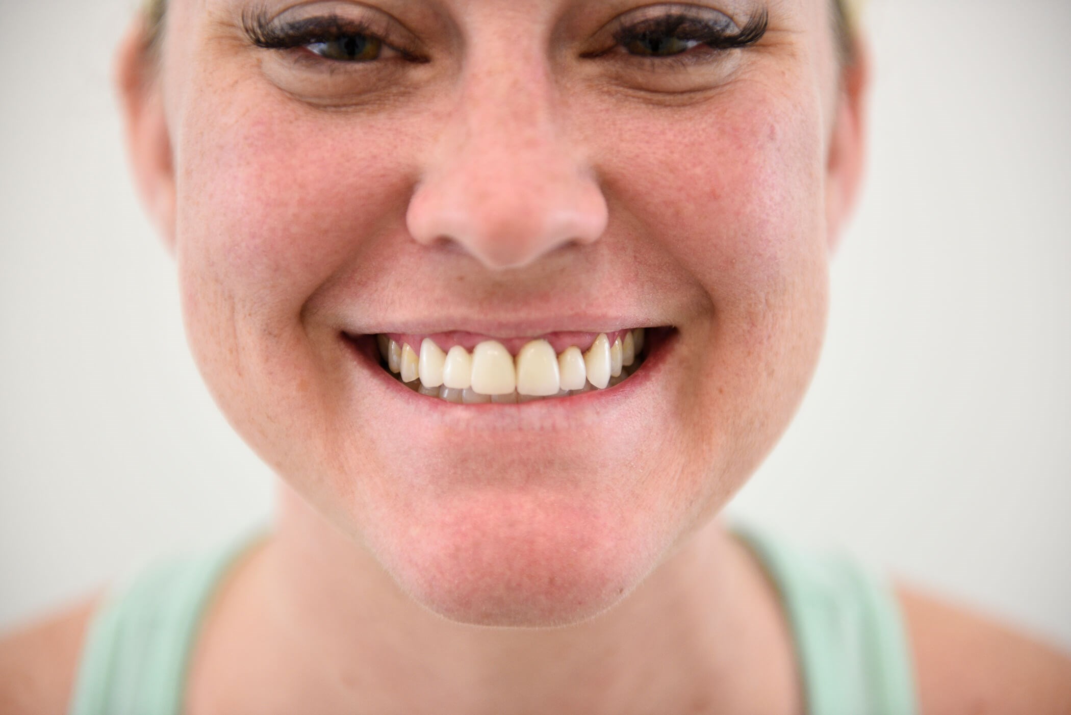 Smile Makeover Before