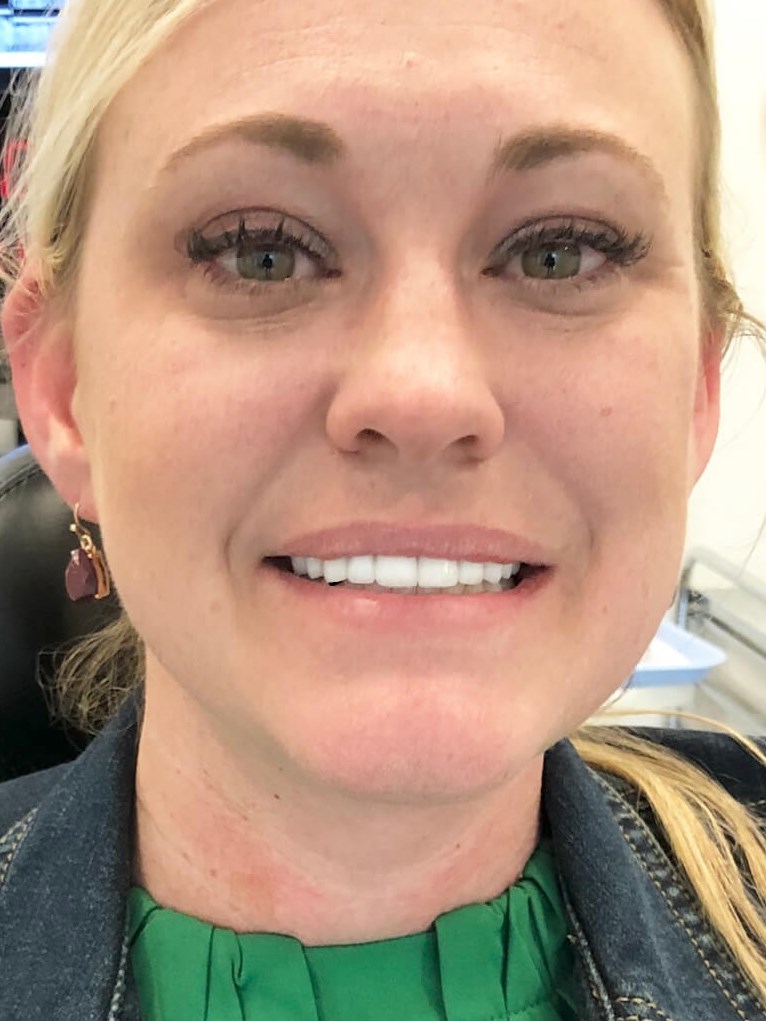 Smile Makeover After