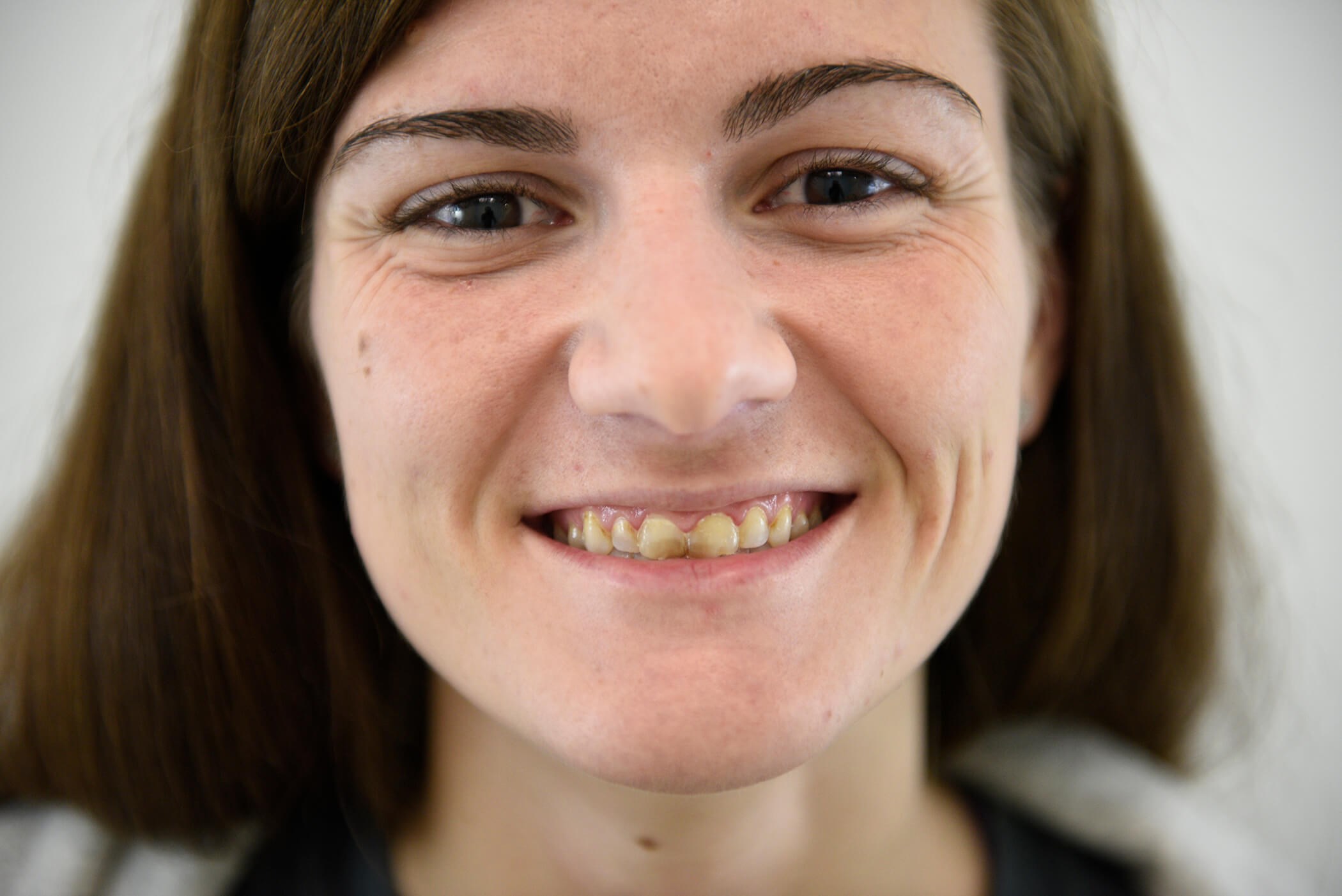 Brand New Smile Before