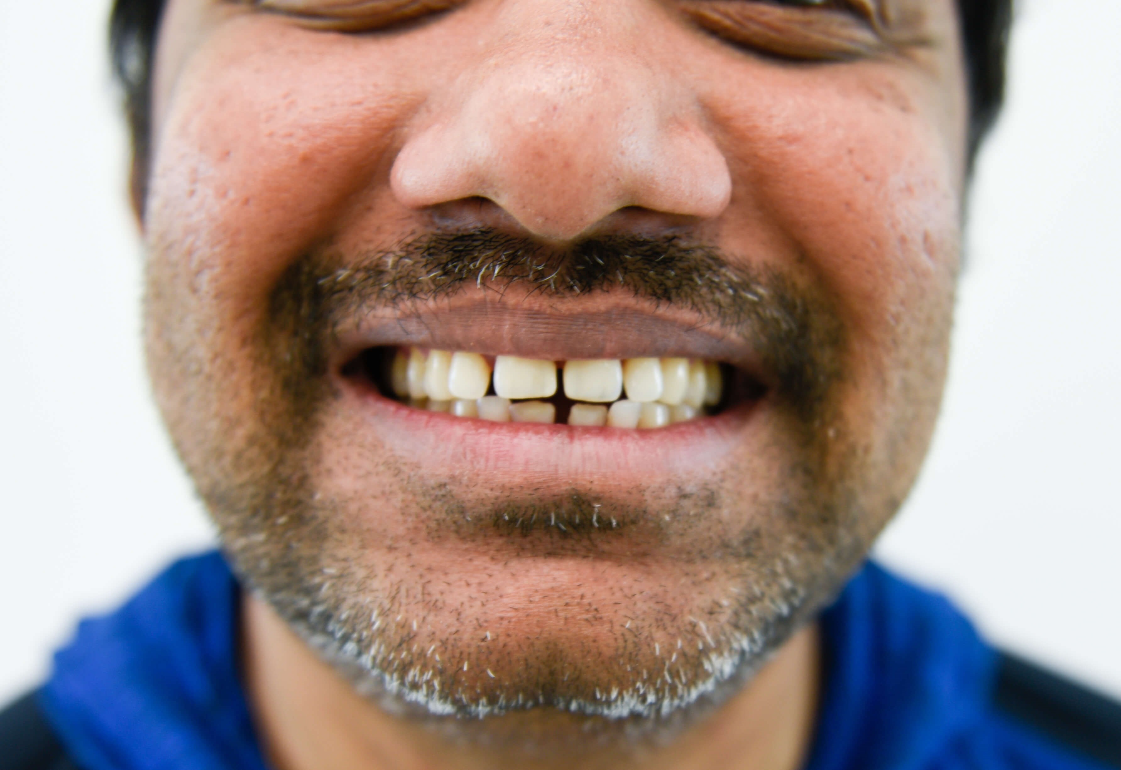 New Smile Without Braces Before