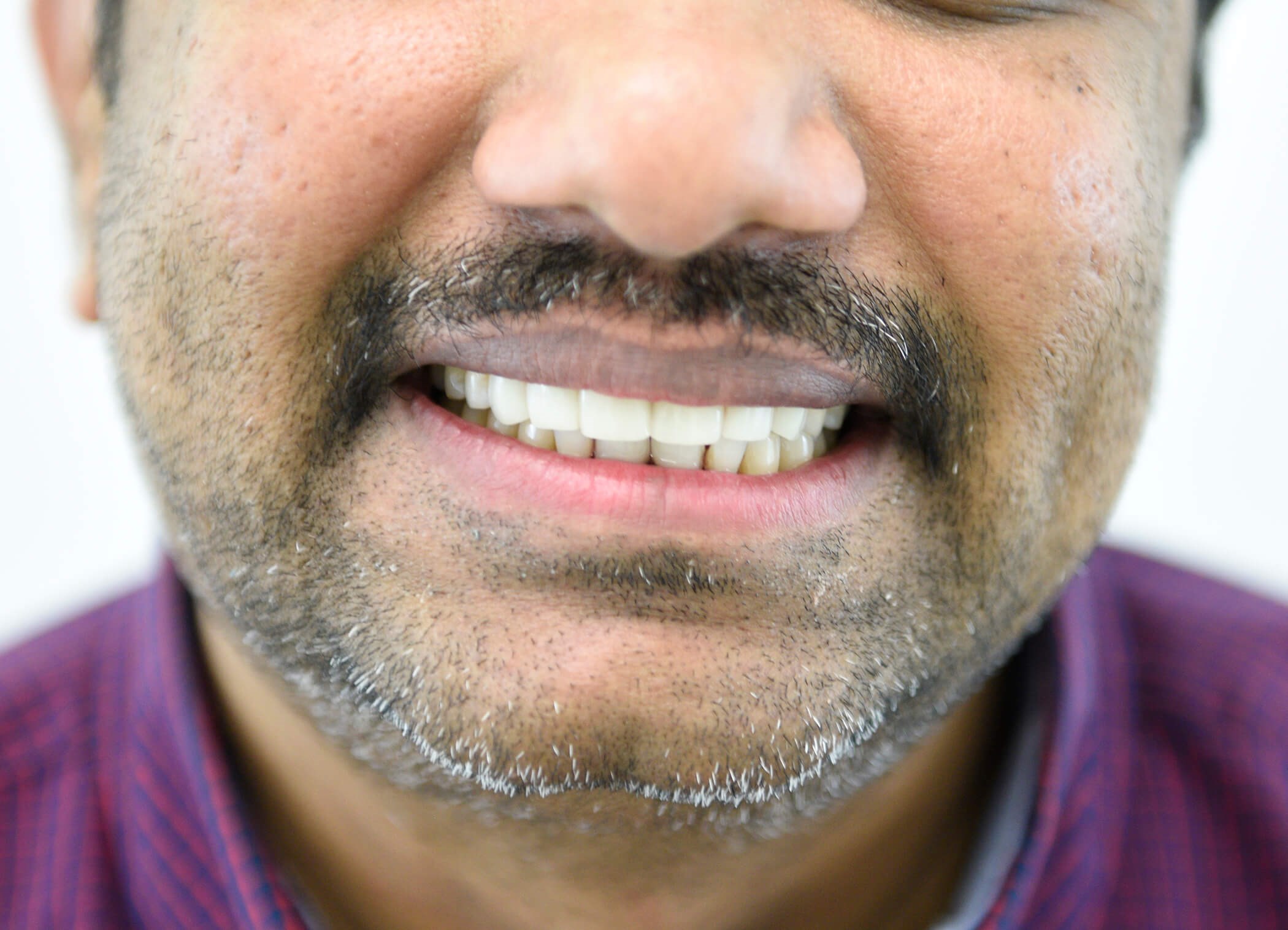 New Smile Without Braces After