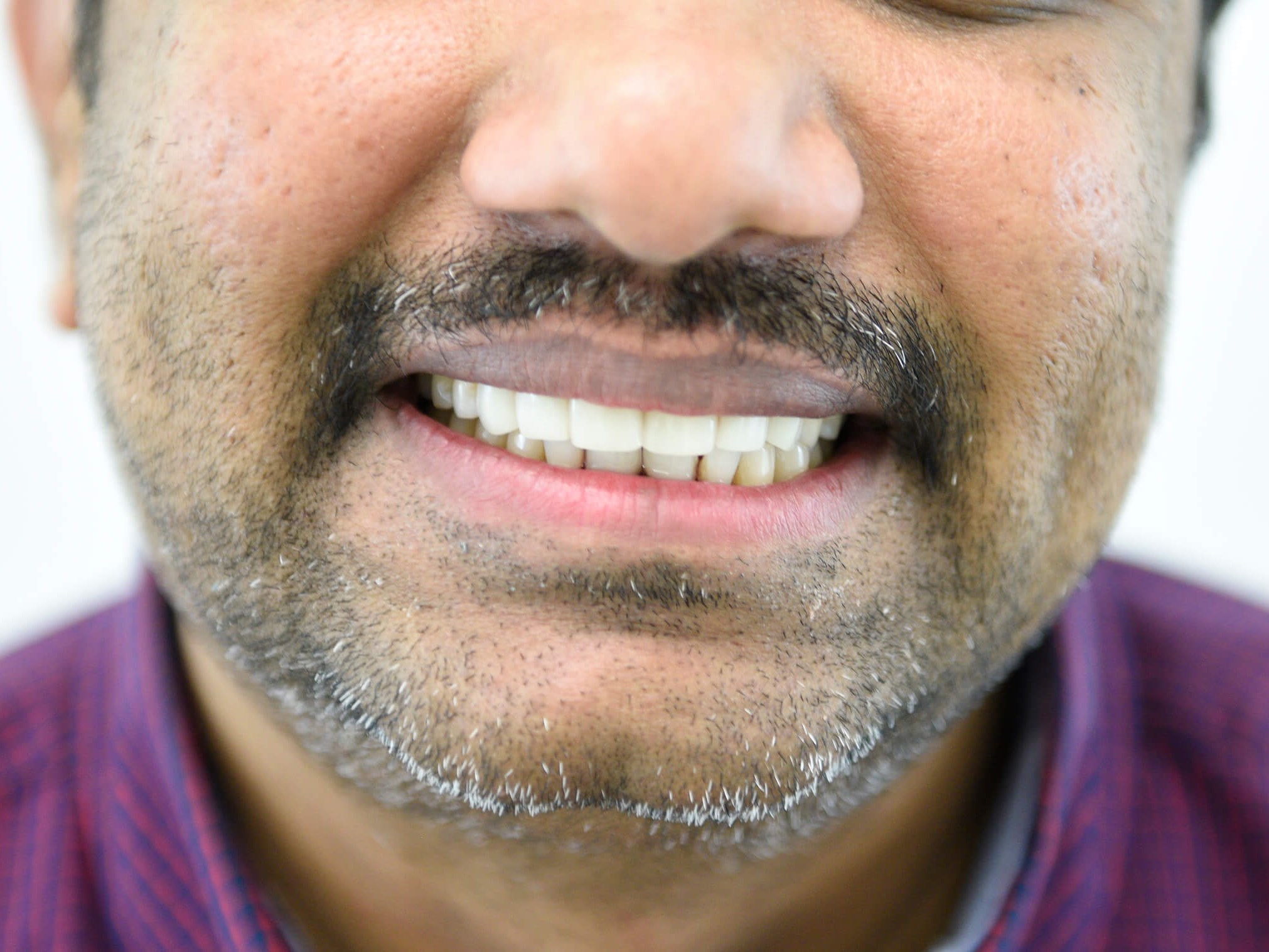 New Smile Without Braces After