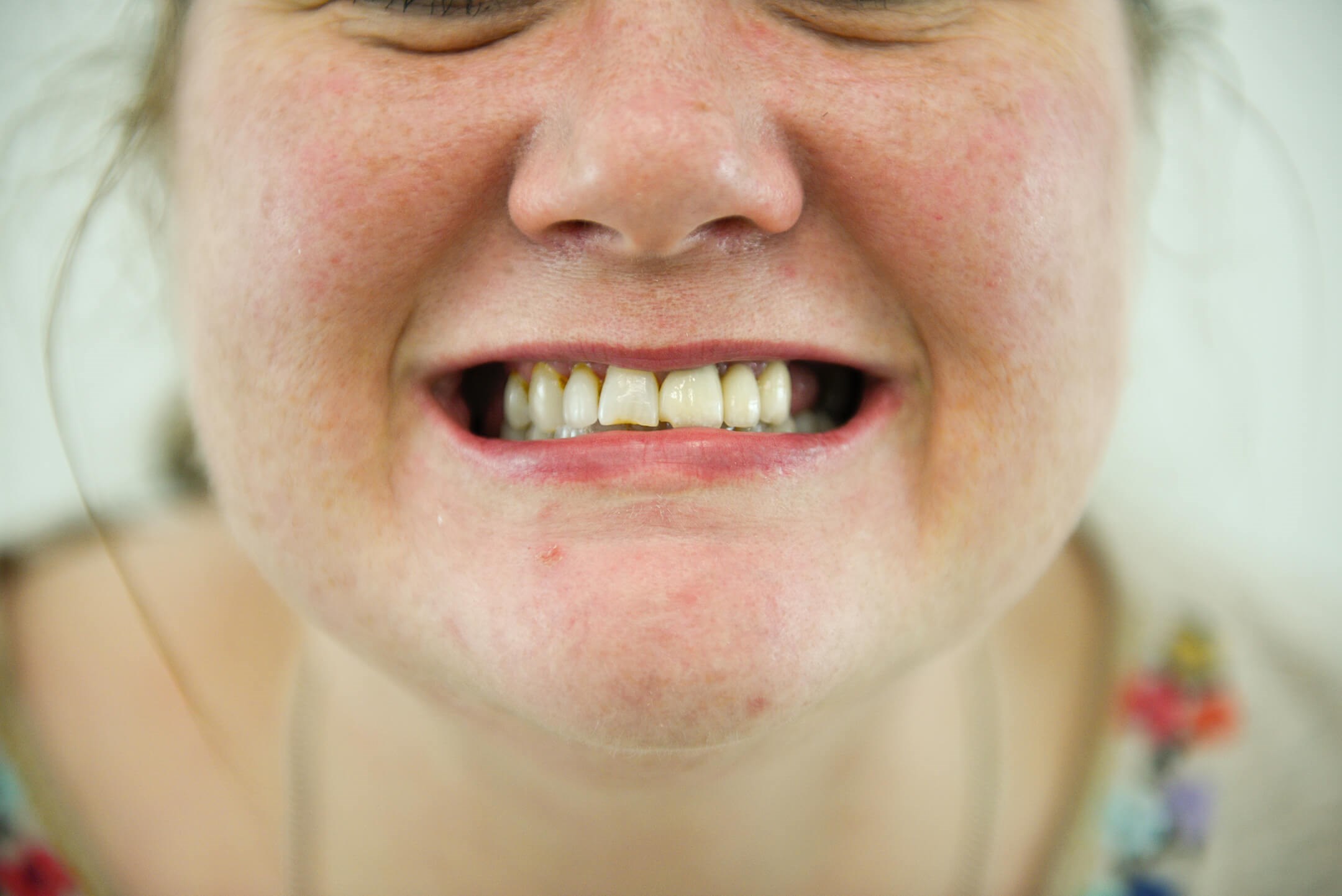 New Smile Design Before