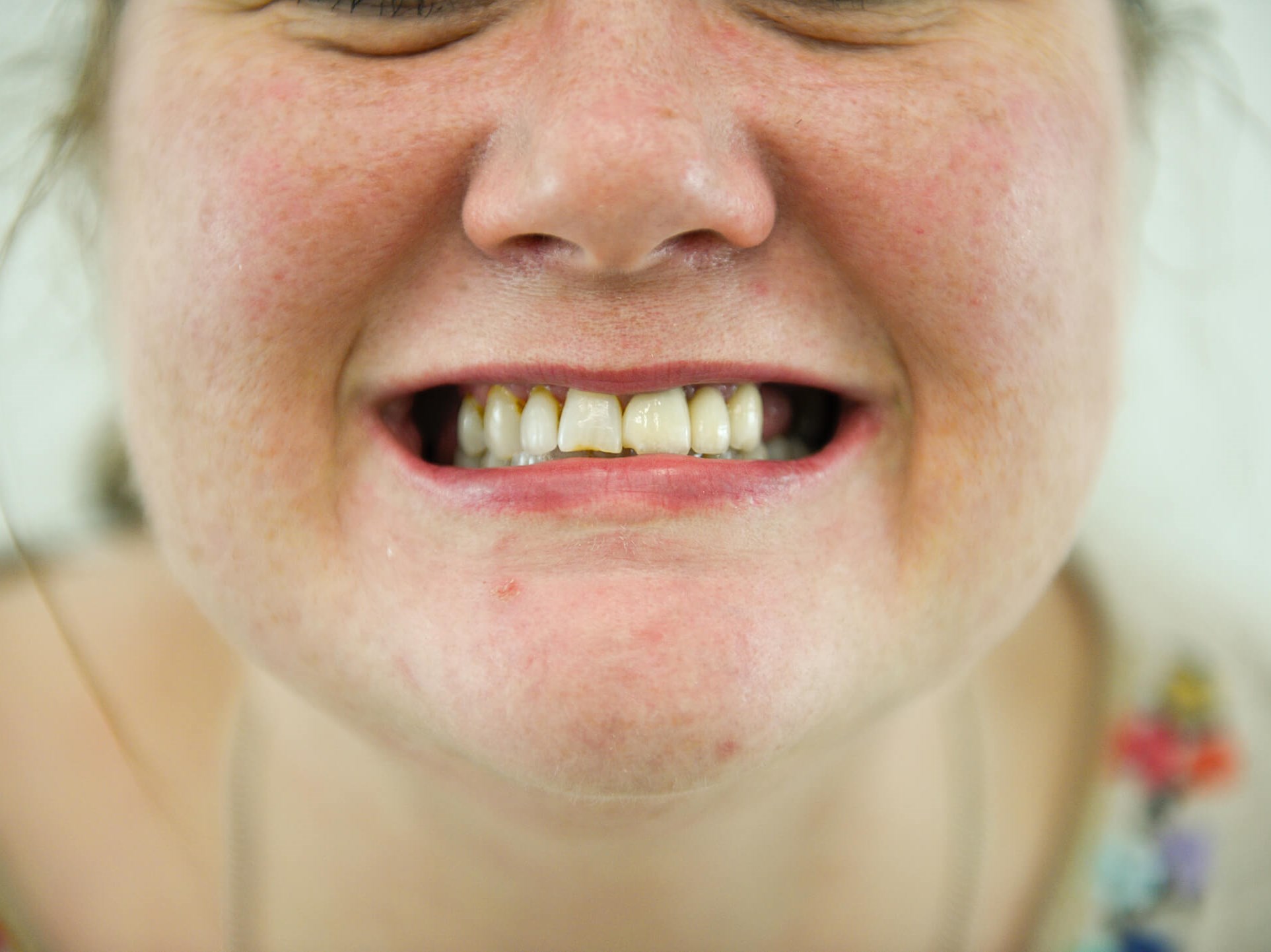 New Smile Design Before