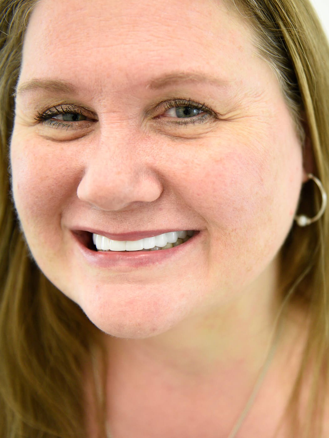 New Smile Design After