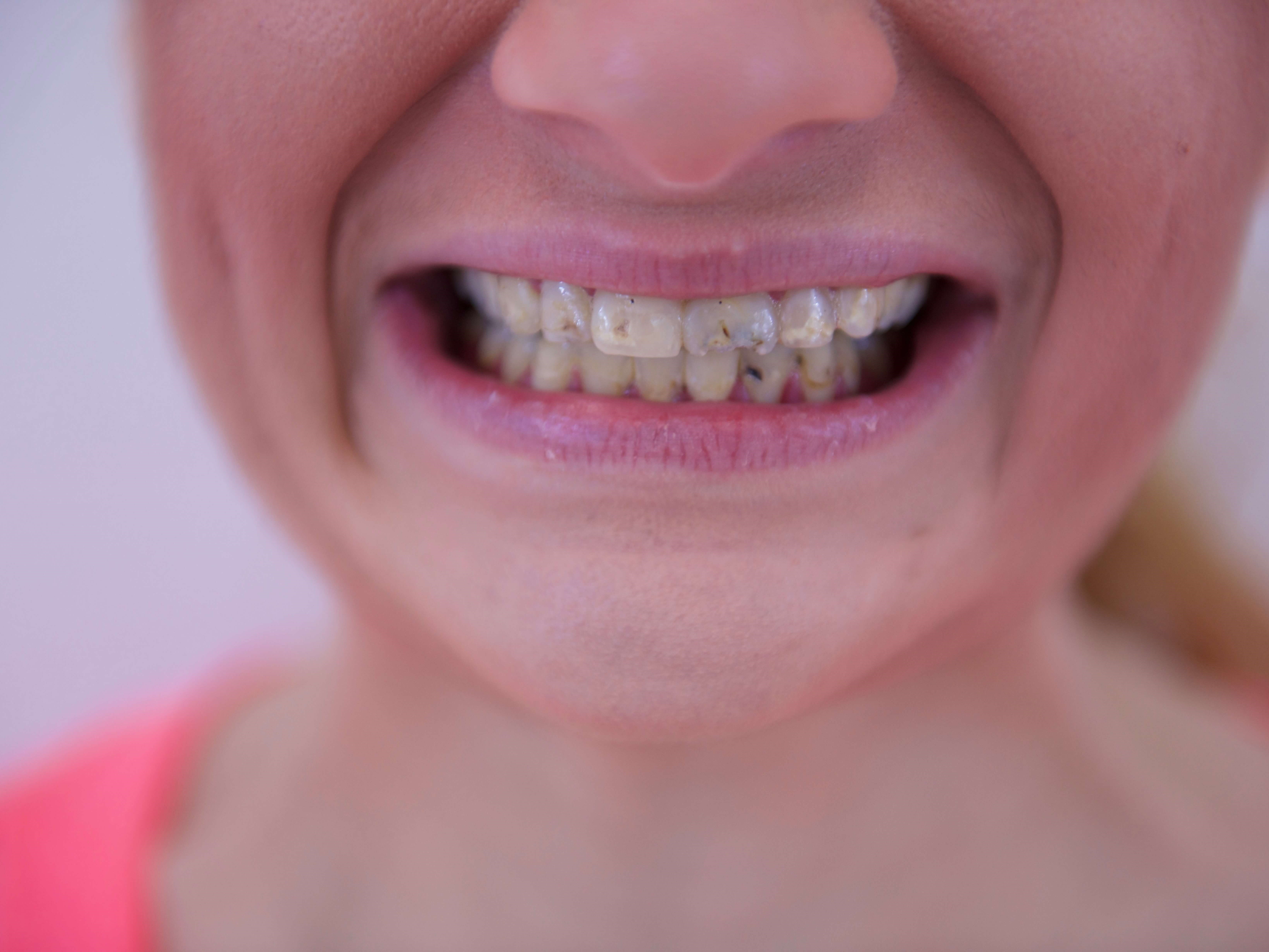 Full Mouth Rehabilitation Before