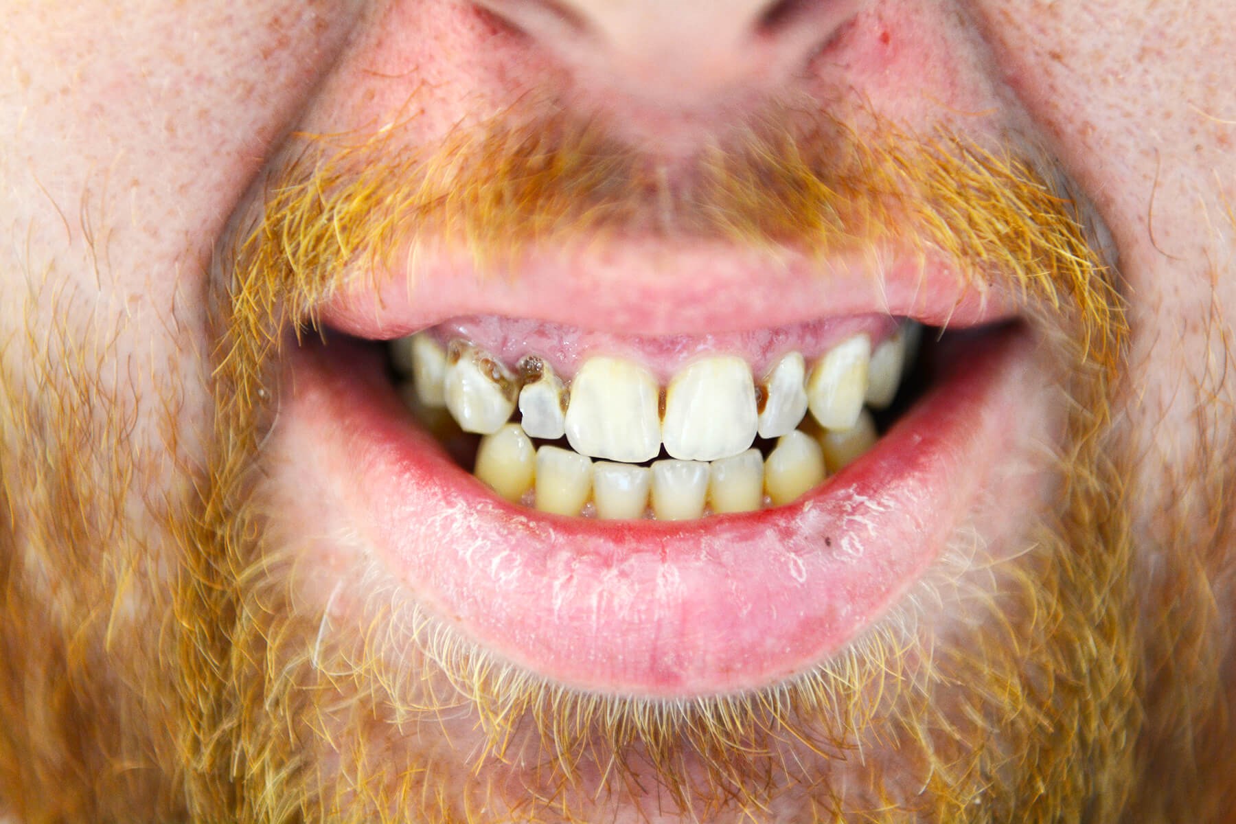 Life Like Porcelain Bridges Before