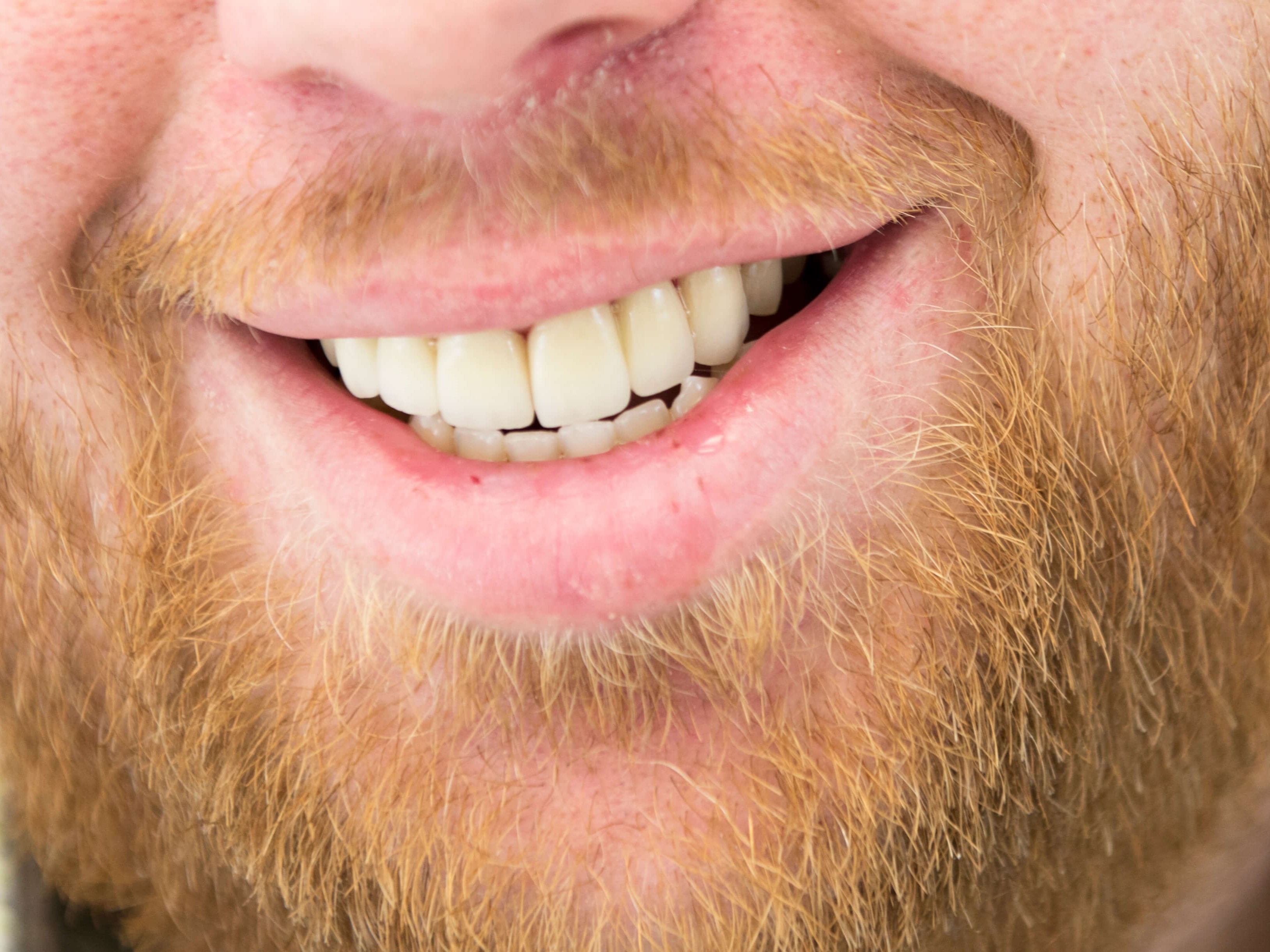 Life Like Porcelain Bridges After