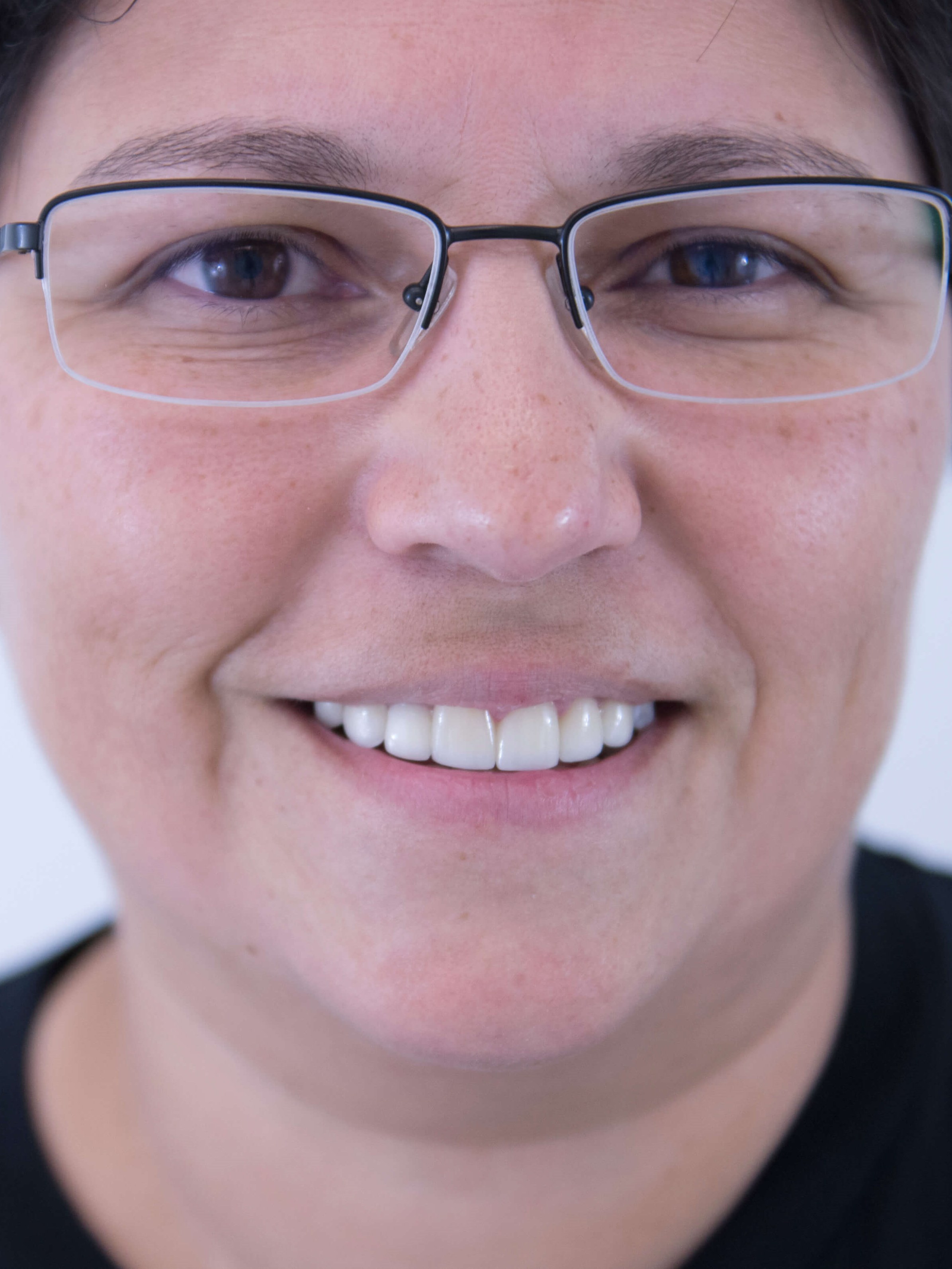 Porcelain Veneers/Crowns After