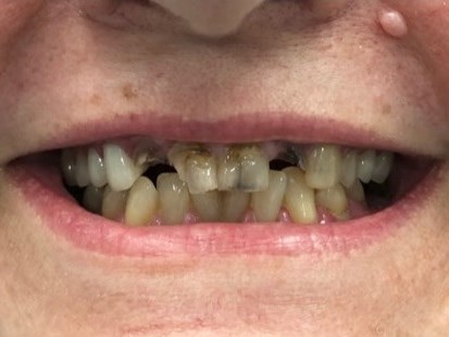 Full Mouth Rehabilitation Before