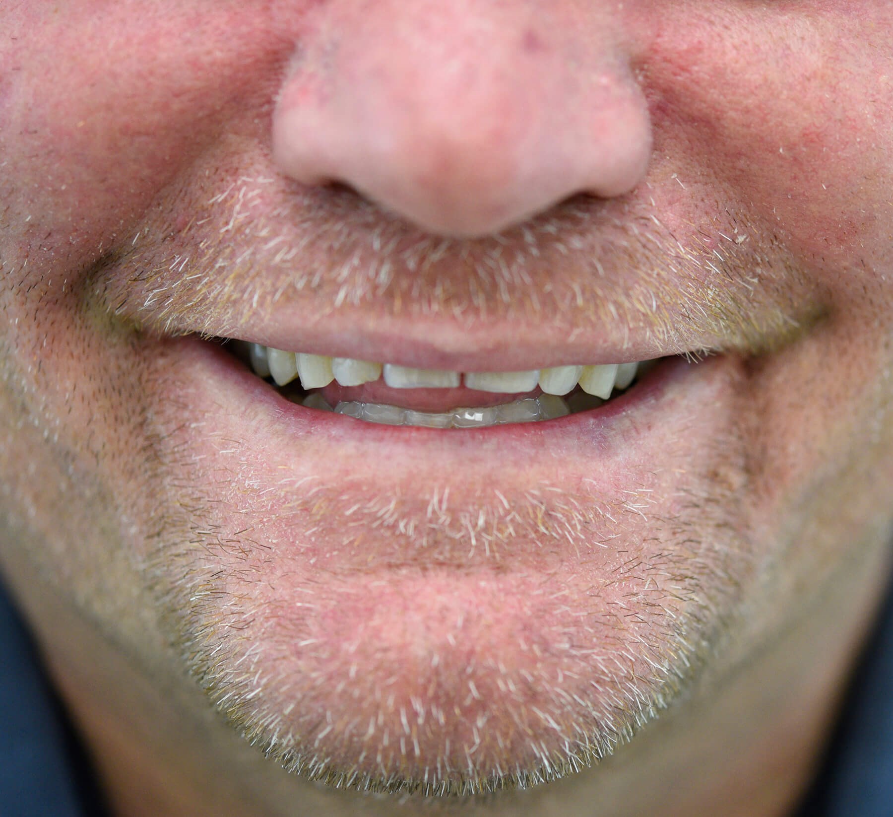 Restoration with Veneers Before