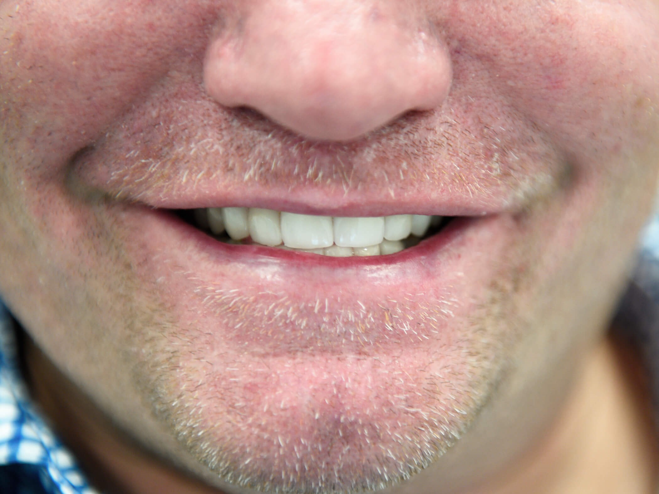 Restoration with Veneers After