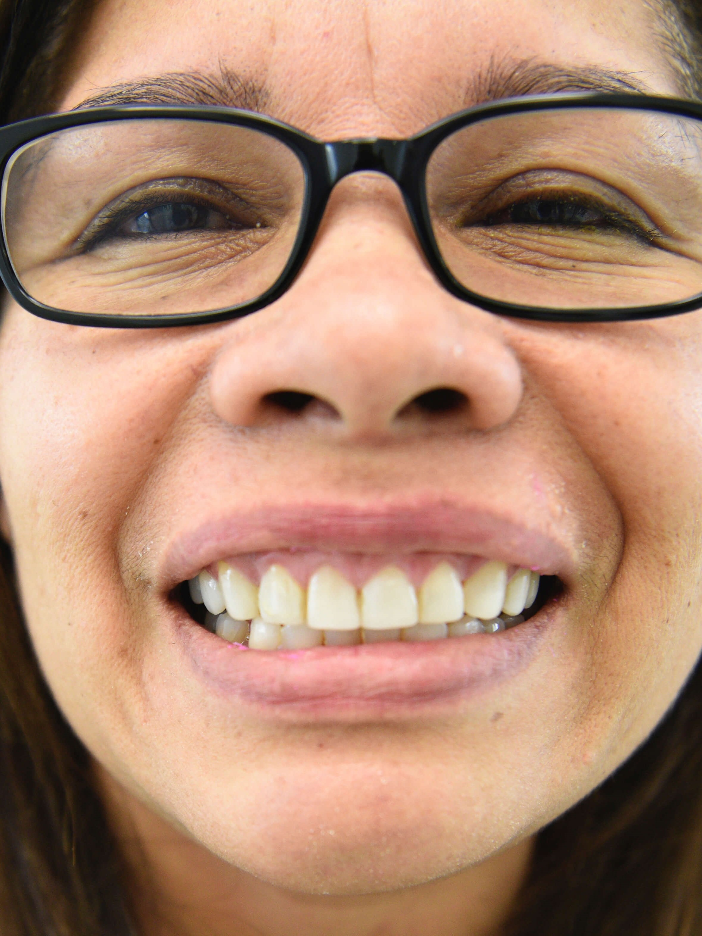 Redo Unhealthy Veneers Before