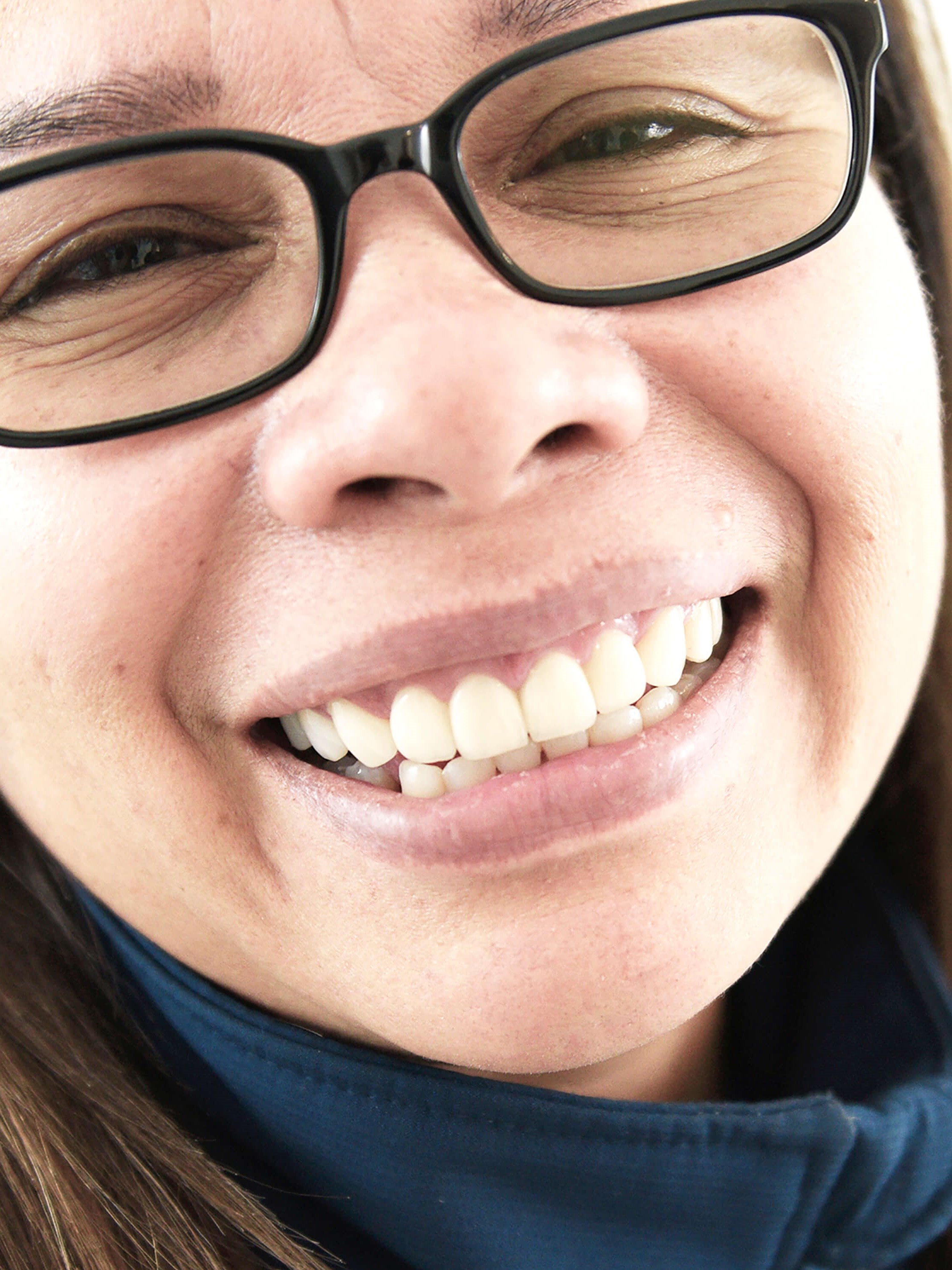 Redo Unhealthy Veneers After