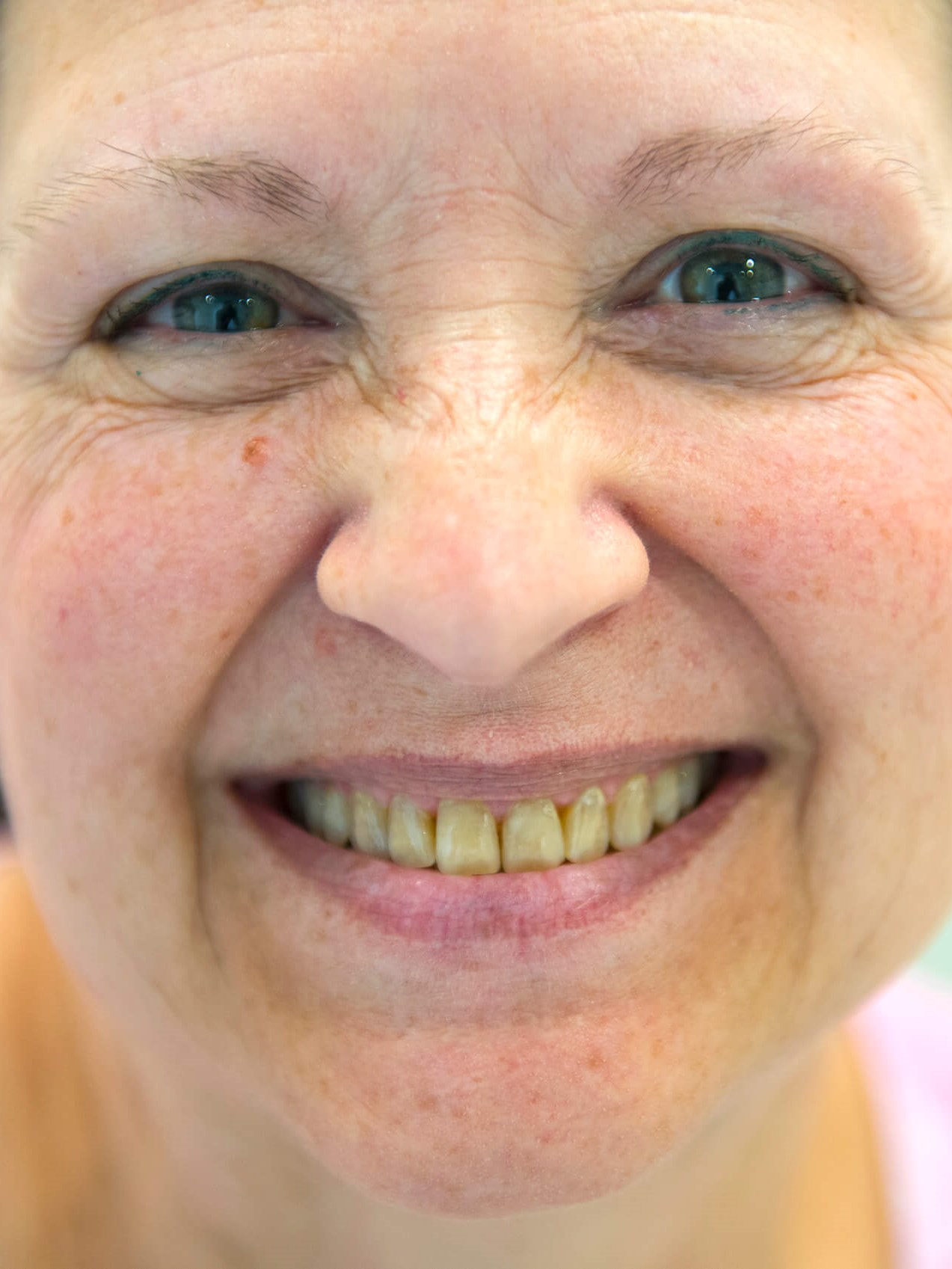 Brand New Smile Before