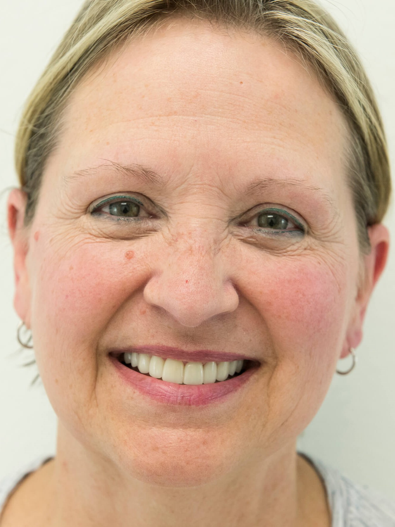 Brand New Smile After