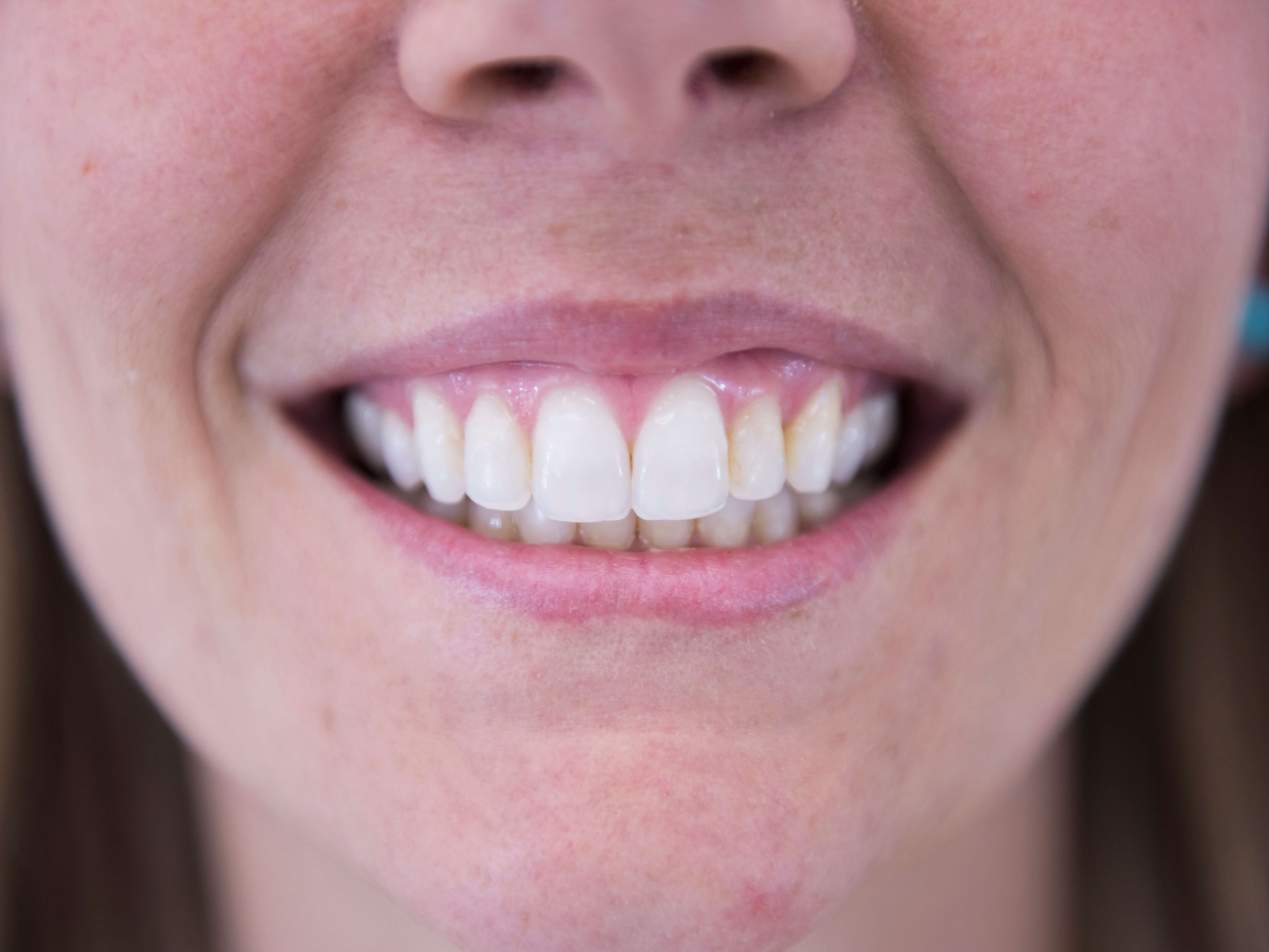 Porcelain Veneers Before