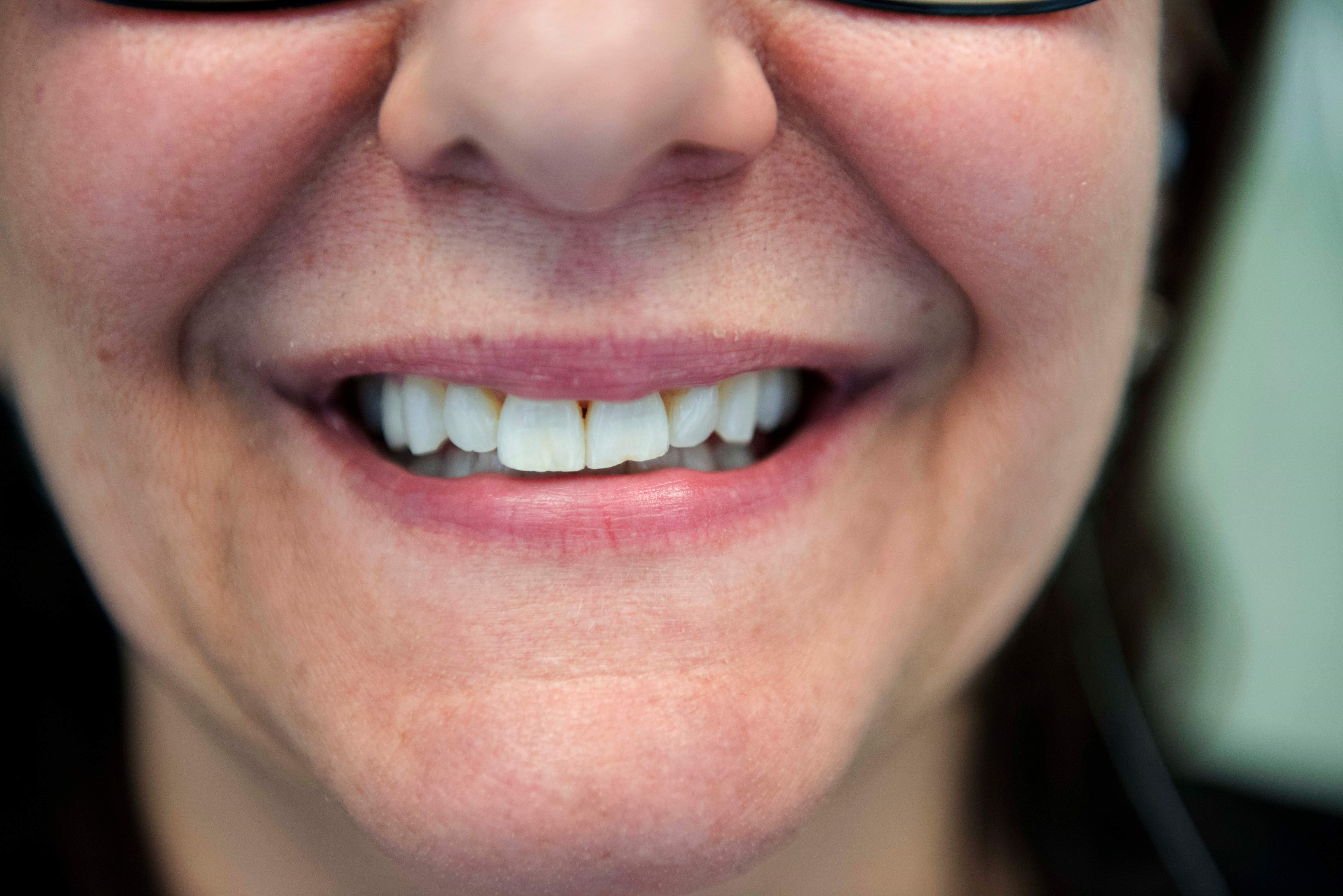 Porcelain Veneers Before