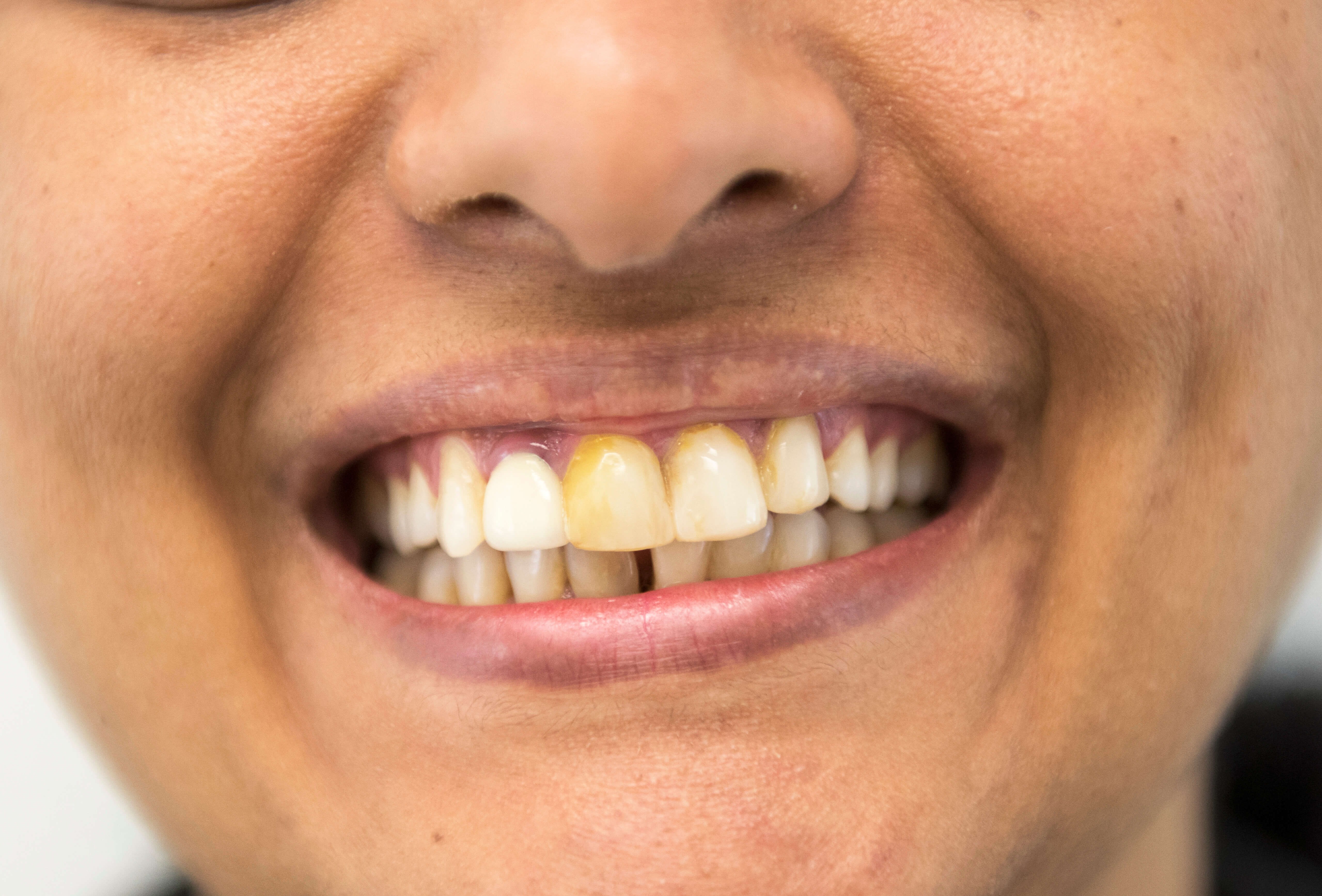 Full Mouth Rehabilitation Before