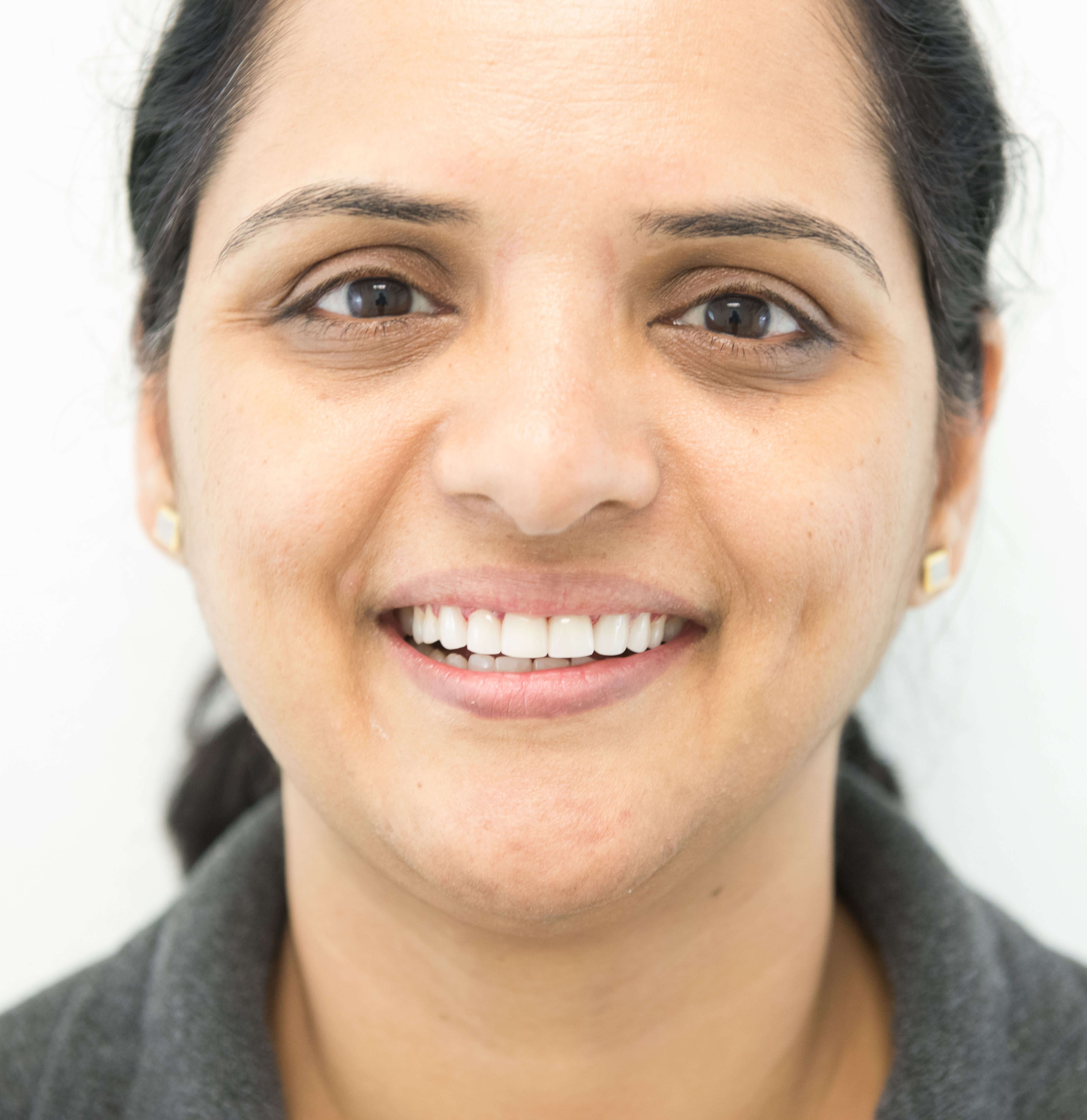 Full Mouth Rehabilitation After