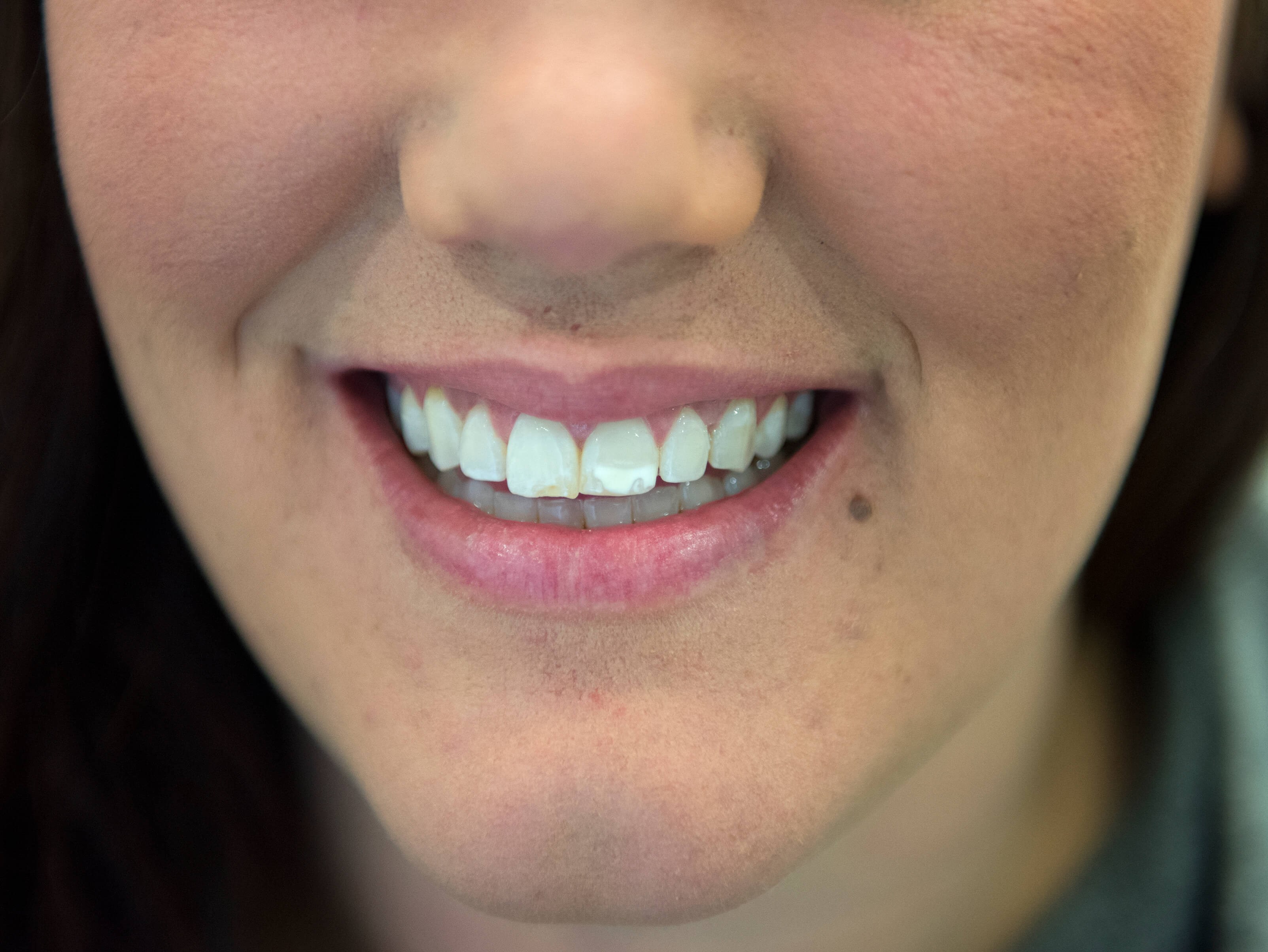 Porcelain Veneers Before