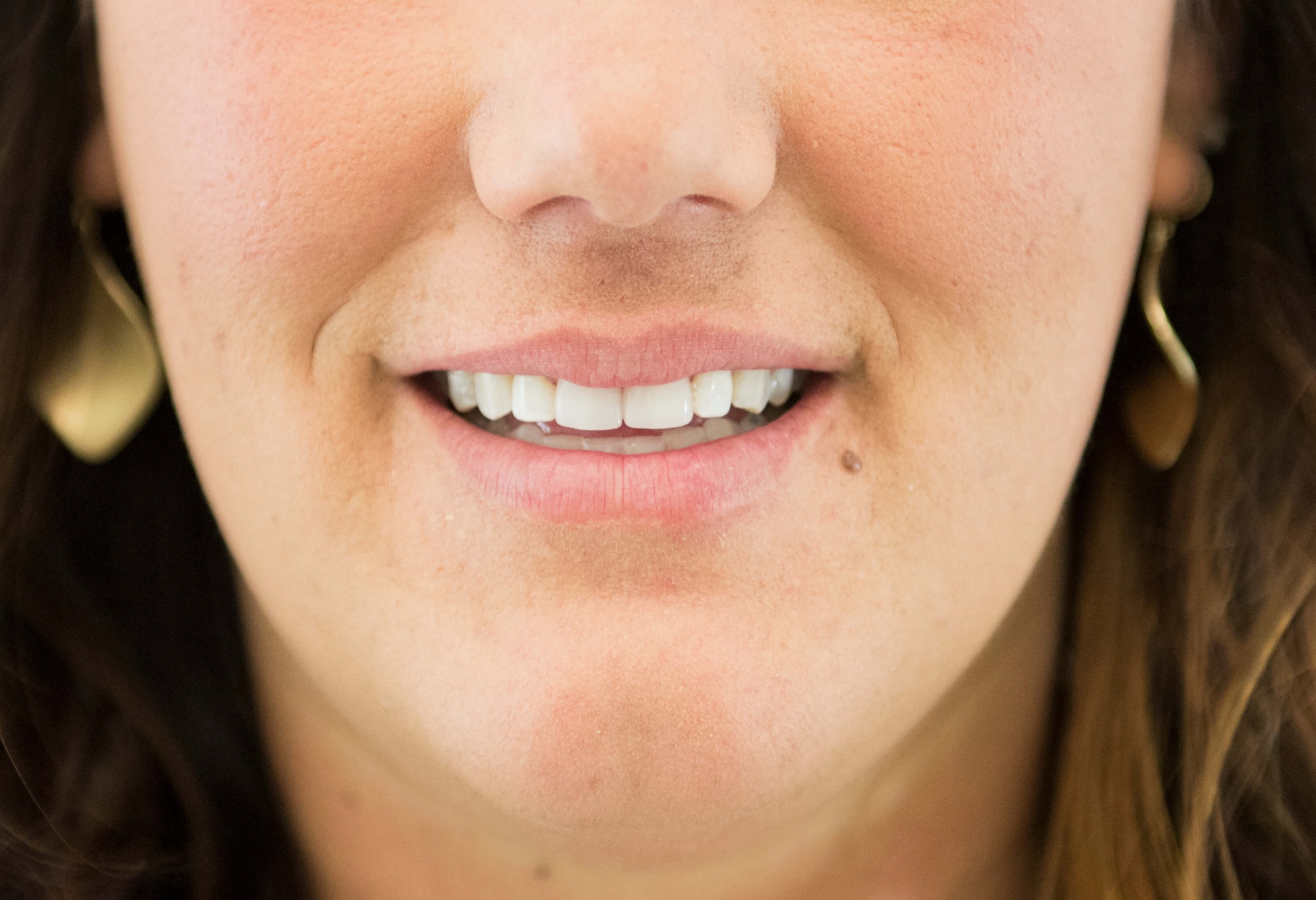 Porcelain Veneers After