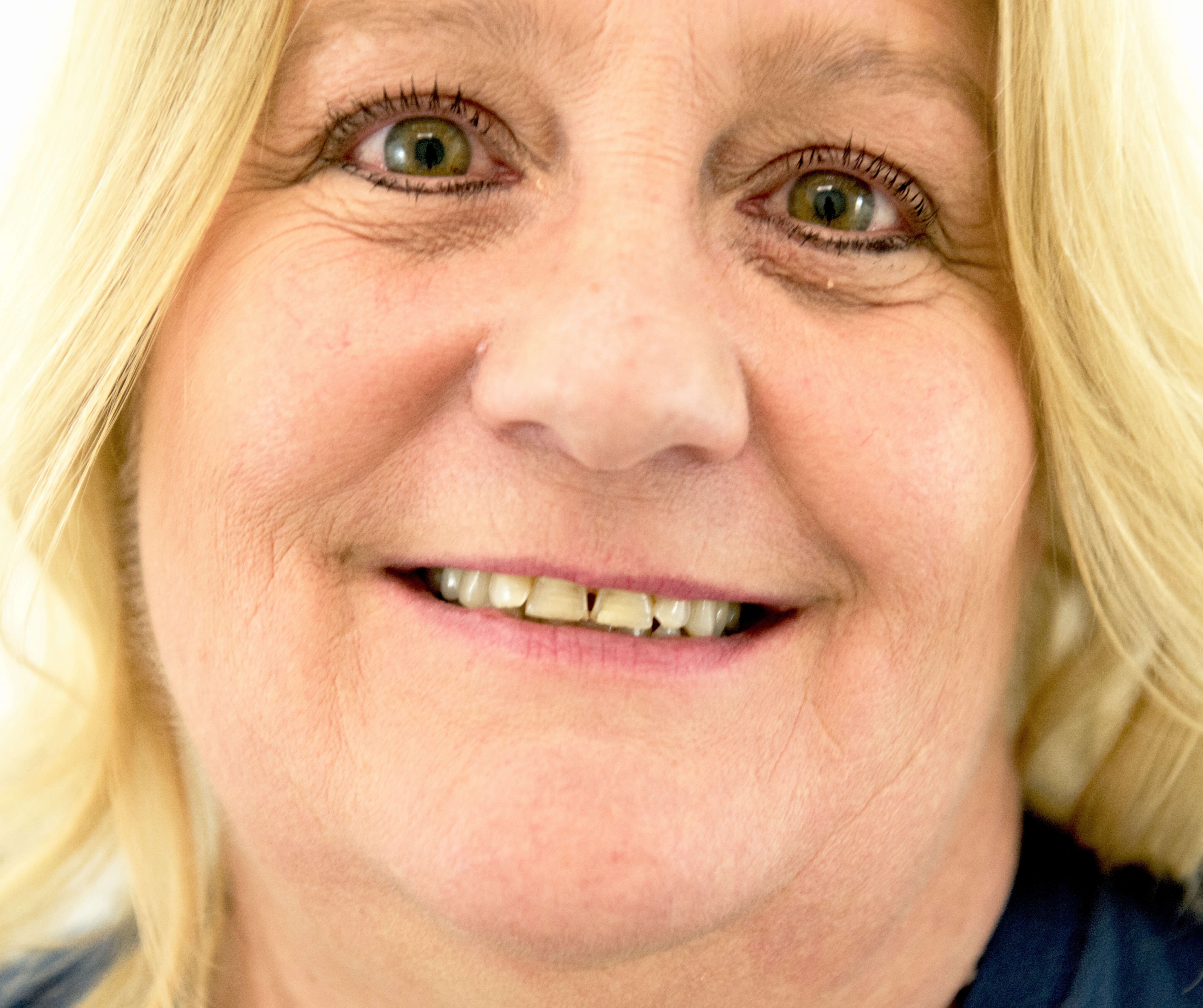 Anti Aging Dentistry Before